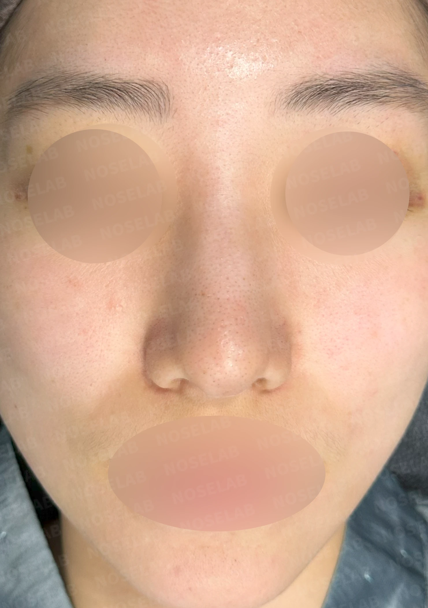 매부리를 정리한 뒤 콧등이 눌려 보이고 코끝이 뭉툭해지는 이유, 보형물 없이 교정하는 방법 — 수술 전 / 수술 직후 0일 직후 사진은 부기가 있는 상태로 최종 결과와 다를 수 있습니다.