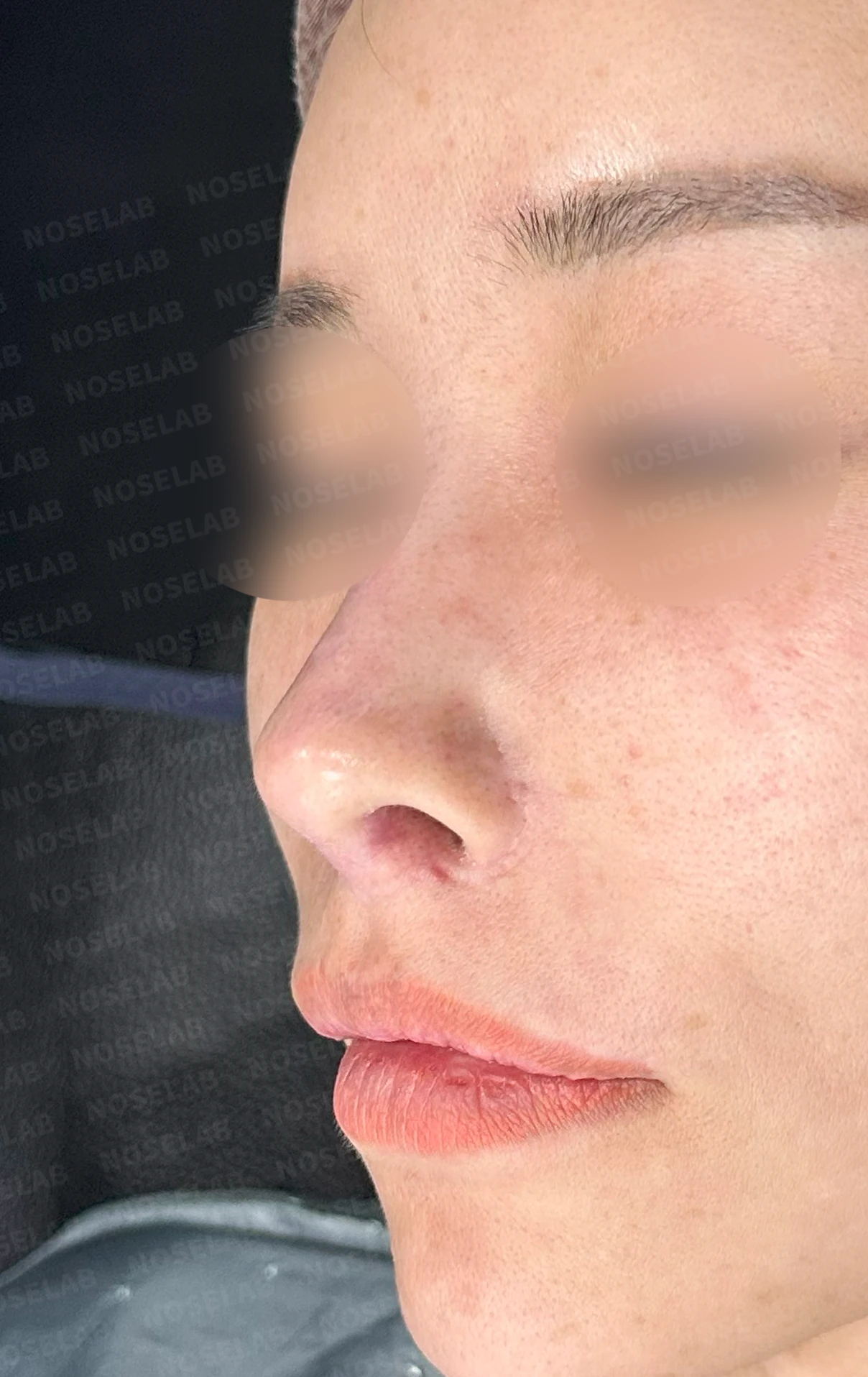 두꺼운 비주와 들린 코끝이 생기는 이유, 자가 늑연골 재건은 어떻게 하나 — 수술 전 / 수술 직후 0일 직후 사진은 부기가 있는 상태로 최종 결과와 다를 수 있습니다.