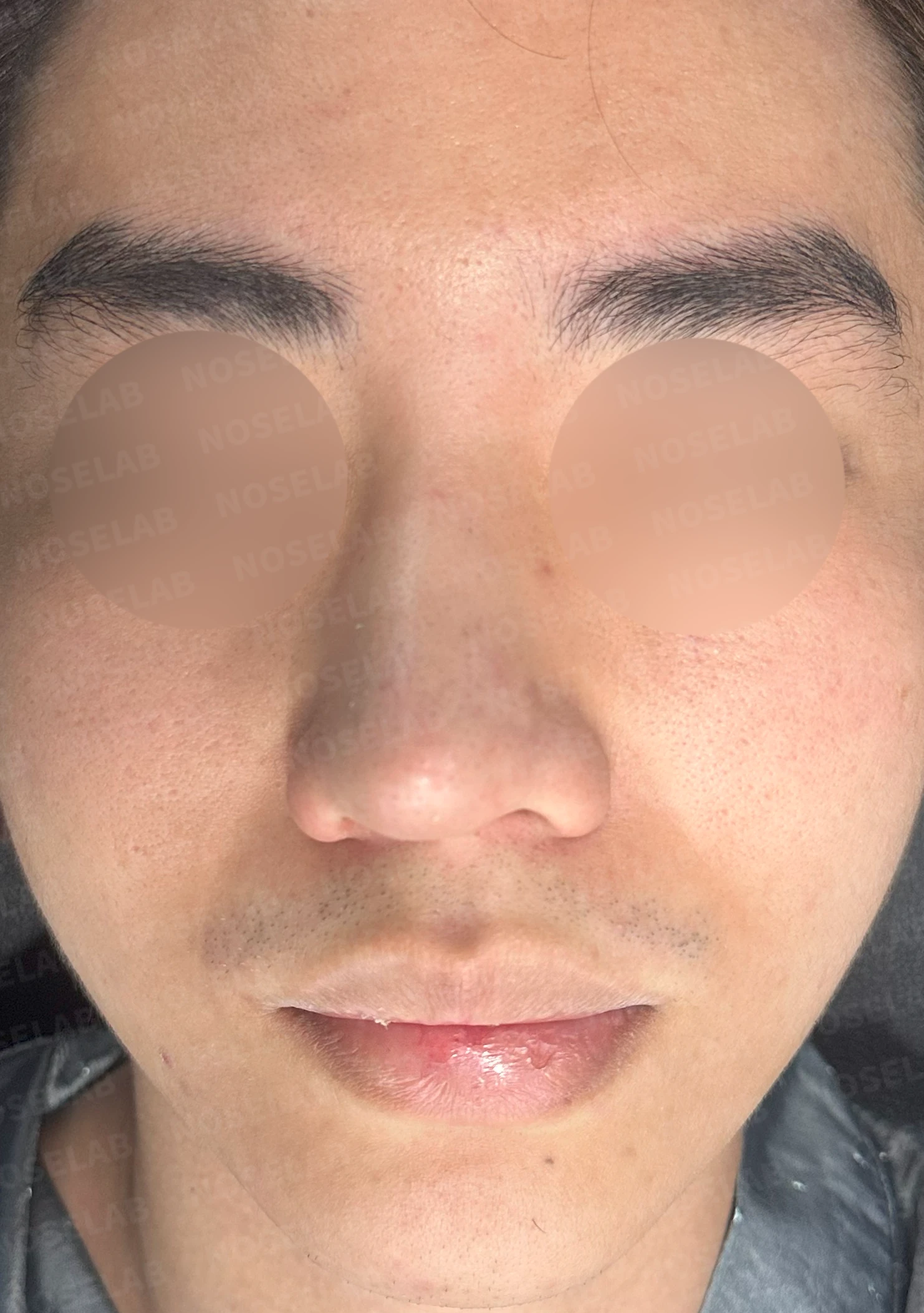 코뼈 골절에 미용 수술을 함께 할 수 있는 경우와 단계로 나누는 방법 — 수술 전 / 수술 직후 0일 직후 사진은 부기가 있는 상태로 최종 결과와 다를 수 있습니다.