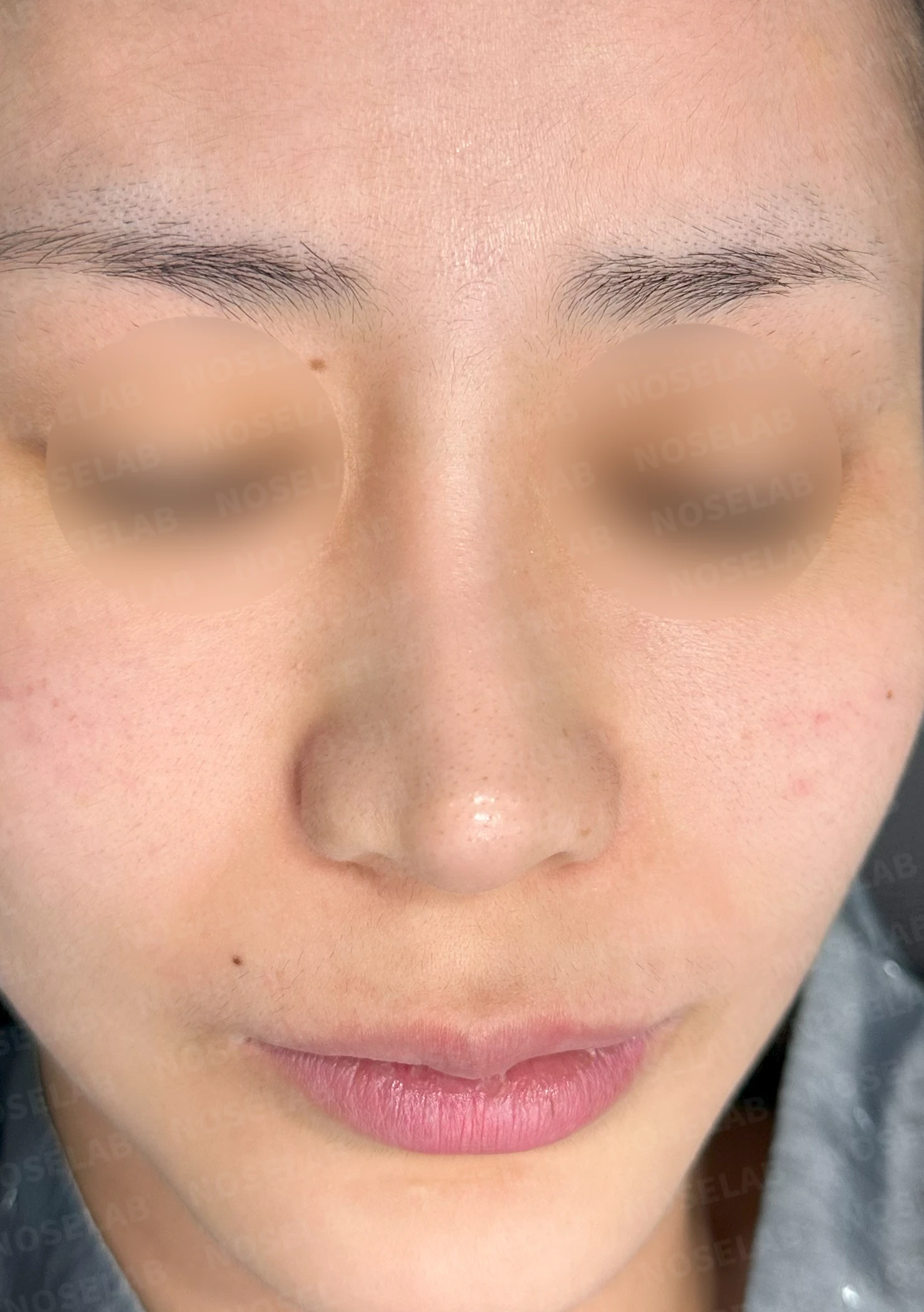 양악수술 뒤 비중격이 손상되고 비염이 재발하는 이유 — 수술 전 / 수술 직후 0일 직후 사진은 부기가 있는 상태로 최종 결과와 다를 수 있습니다.