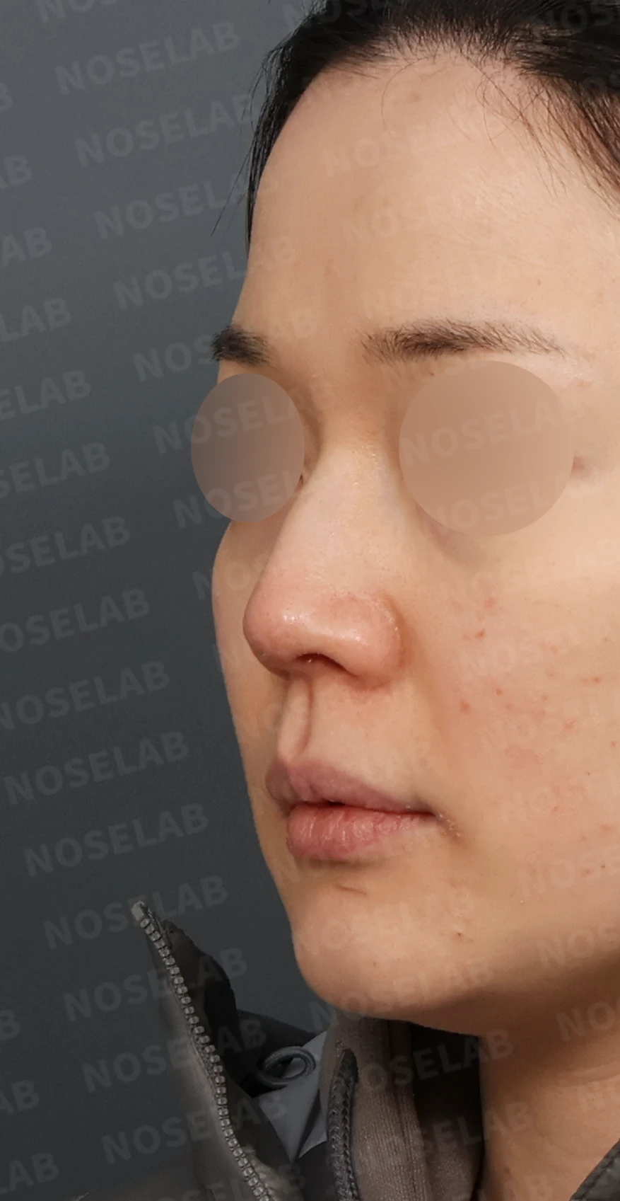 매부리코 교정, 처진 코끝을 오똑하게 바꾸는 비개방 코성형 — 디자인 상담 정면, 좌측 측면, 비스듬한 측면 사진입니다.
