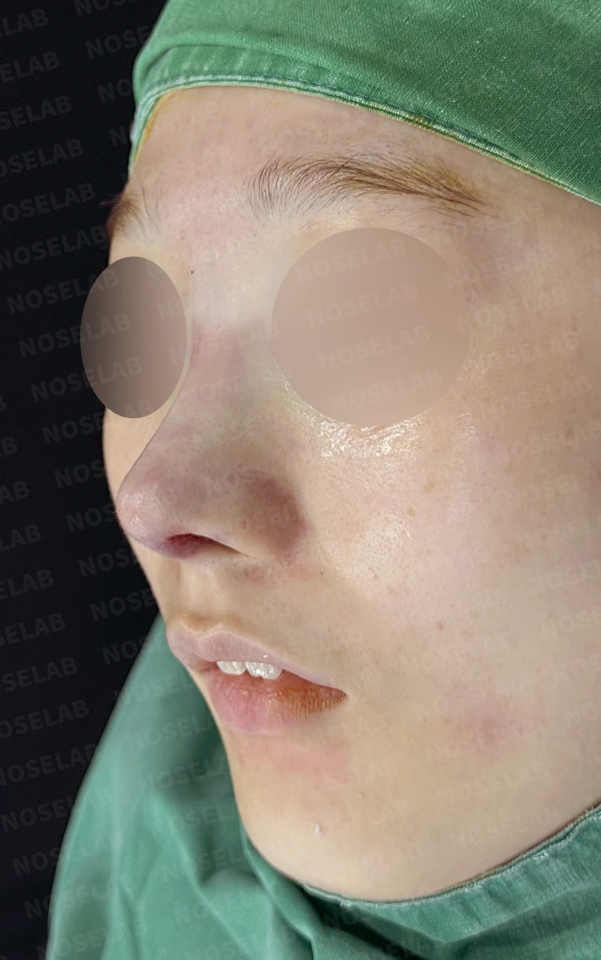 퍼진 코끝에 코막힘이 함께 오는 이유, 이물질 제거와 재건은 어떻게 하나 — 수술 직후 0일 정면, 비스듬한 측면, 측면 사진입니다. 직후 사진은 부기가 있는 상태로 최종 결과와 다를 수 있습니다.
