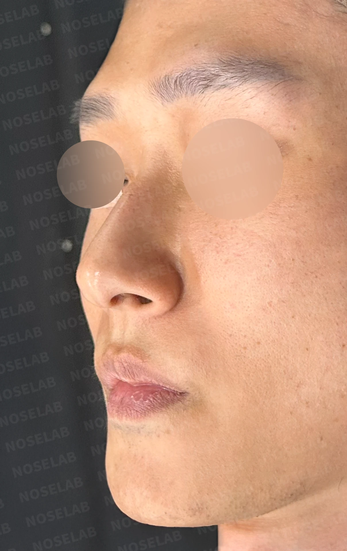 안면 비대칭이 있는 코에 맞춤형 보형물을 쓰는 이유와 매부리 교정 방법 — 본문 사진 12