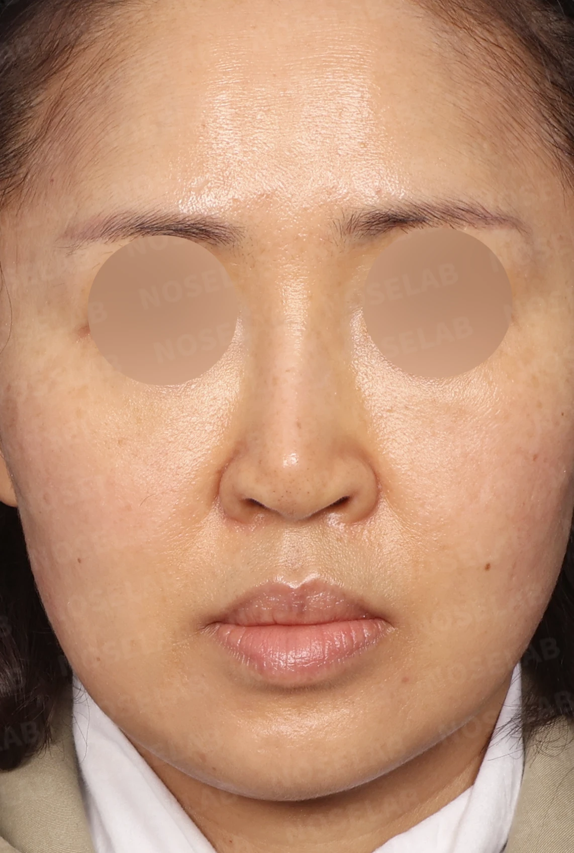 보형물 비침과 용코, 자가늑연골로 안전하게 교정한 코재수술 — 디자인 상담 정면, 좌측 측면, 비스듬한 측면 사진입니다.