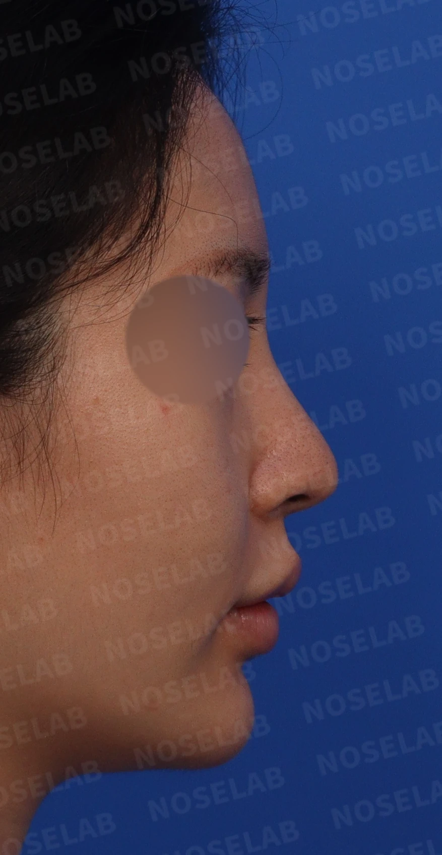 여러 코 모양 고민을 함께 살펴보는 코성형 계획 — 수술전 디자인 상담 우측 측면, 비스듬한 측면, 콧구멍 사진입니다.