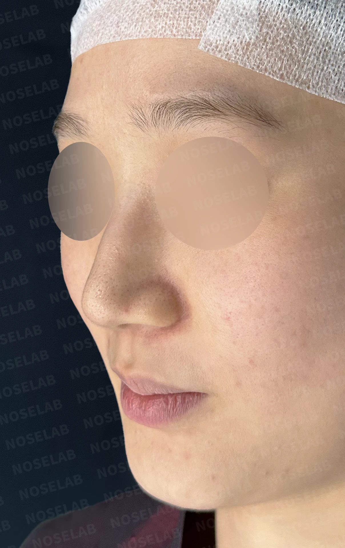 퍼진 코끝에 코막힘이 함께 오는 이유, 이물질 제거와 재건은 어떻게 하나 — 수술 전 / 수술 직후 0일 직후 사진은 부기가 있는 상태로 최종 결과와 다를 수 있습니다.