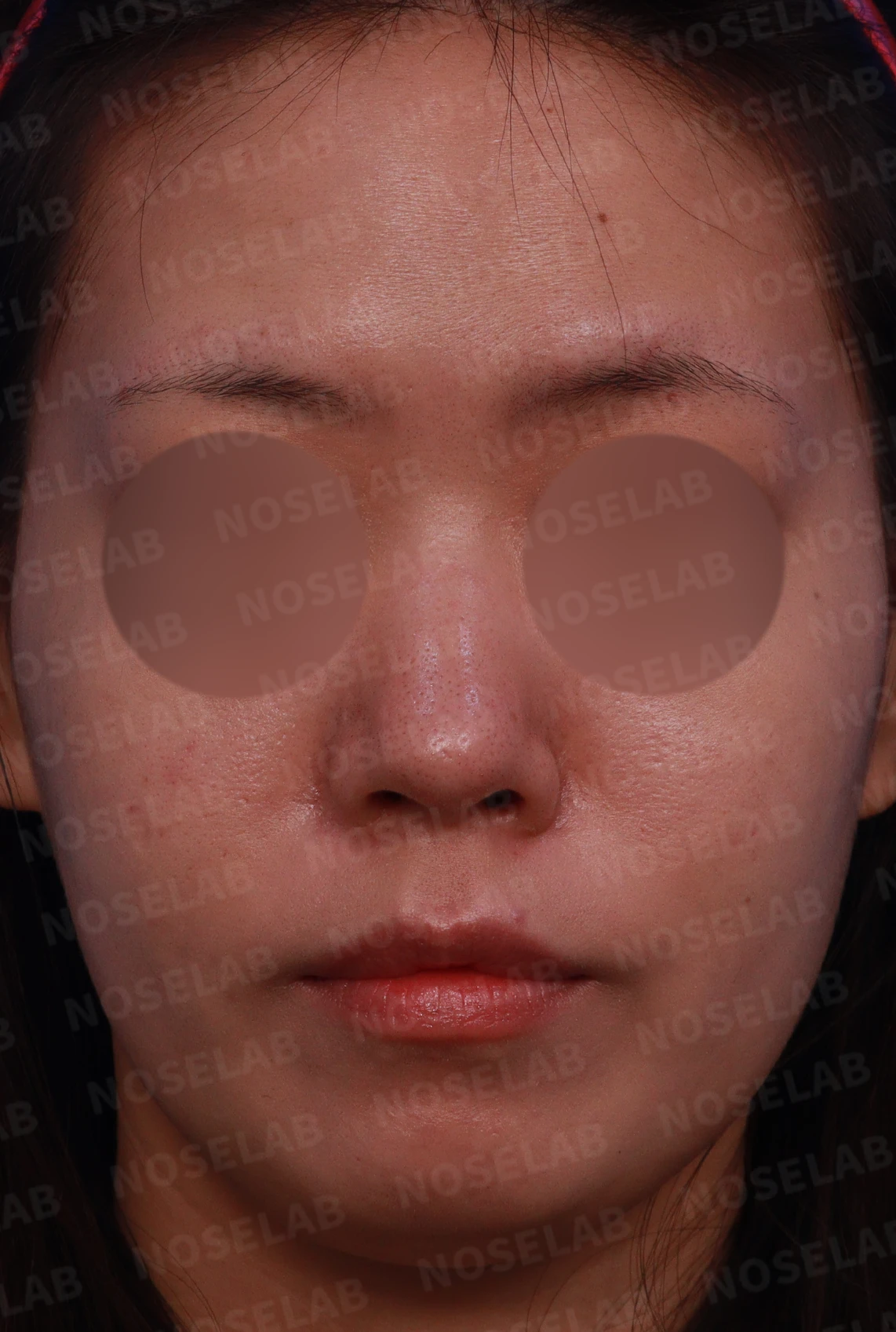 재수술 뒤에도 복코와 퍼진 코끝이 남는 이유, 자가 늑연골 재건은 어떻게 하나 — 디자인 상담 정면, 좌측 측면, 비스듬한 측면 사진
