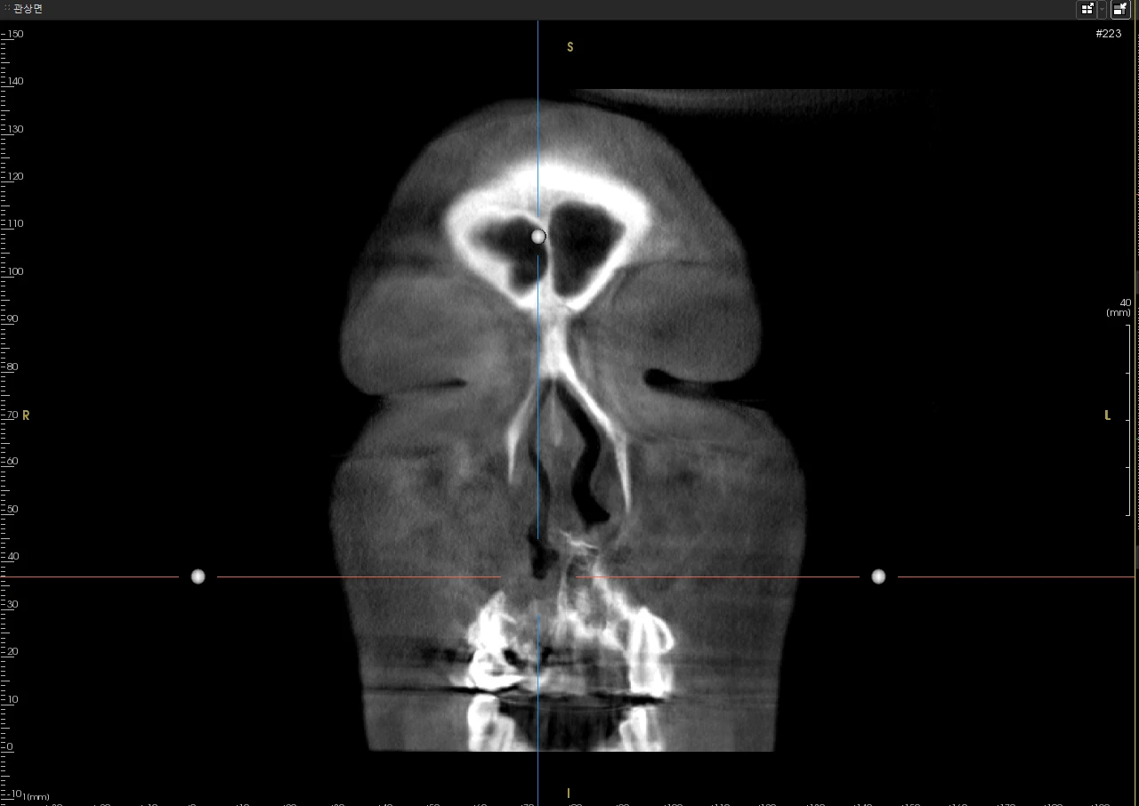 구순구개열에 동반된 코 변형의 교정 방법 — 1. 안면부 CT 영상(원본이미지) 2. 안면부 3차원 CT 영상(원본 이미지)