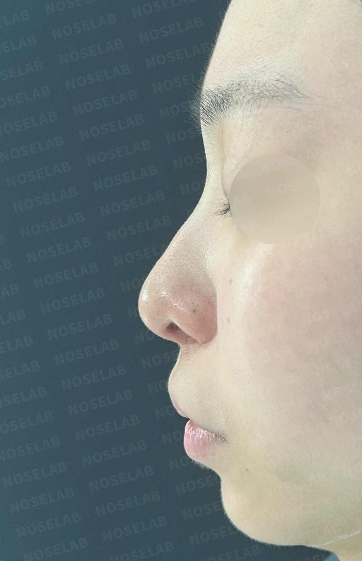 여러 번 수술해도 콧대가 낮고 복코가 남는 이유, 늑연골 재건과 얼굴 균형 — 본문 사진 9