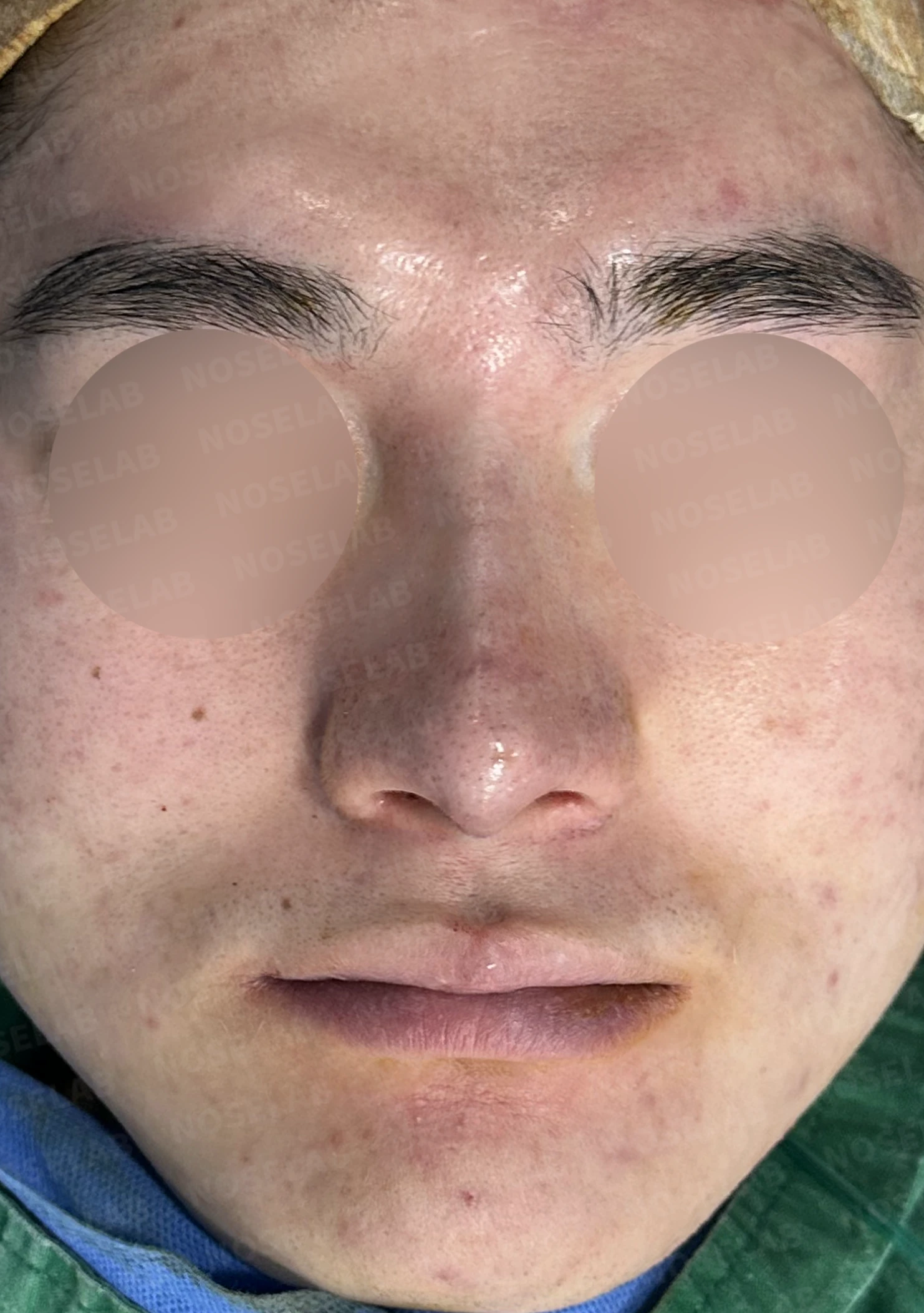 콧대를 더 높이고 싶을 때 무엇이 한계를 만드나, 3D 맞춤 보형물과 자가늑연골 코끝 지지 — 수술 전 / 수술 직후 0일 직후 사진은 부기가 있는 상태로 최종 결과와 다를 수 있습니다.