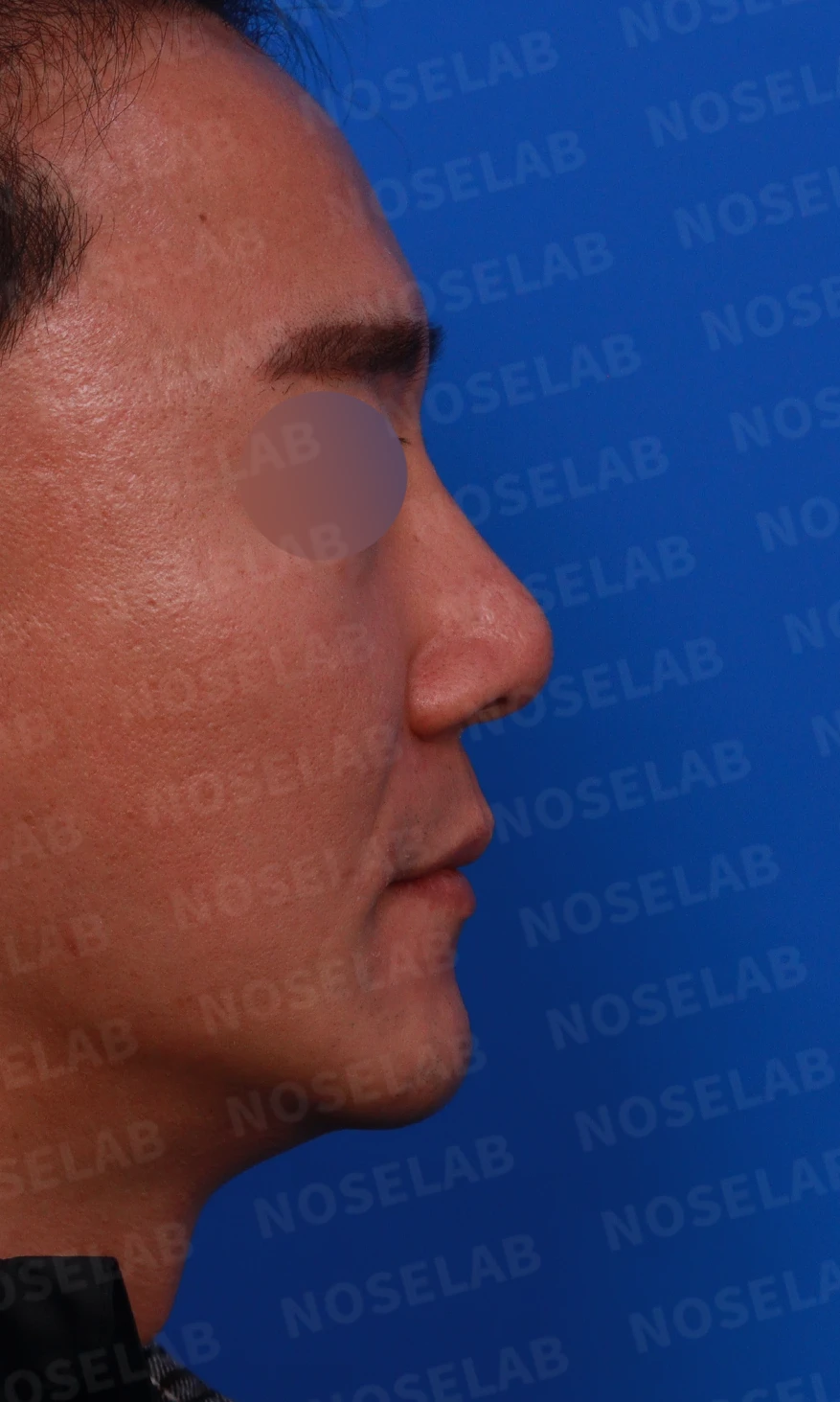 휜코와 코막힘, 코끝 구조를 함께 교정하는 방법 — 디자인 상담 우측 측면, 비스듬한 측면, 비공 사진입니다.