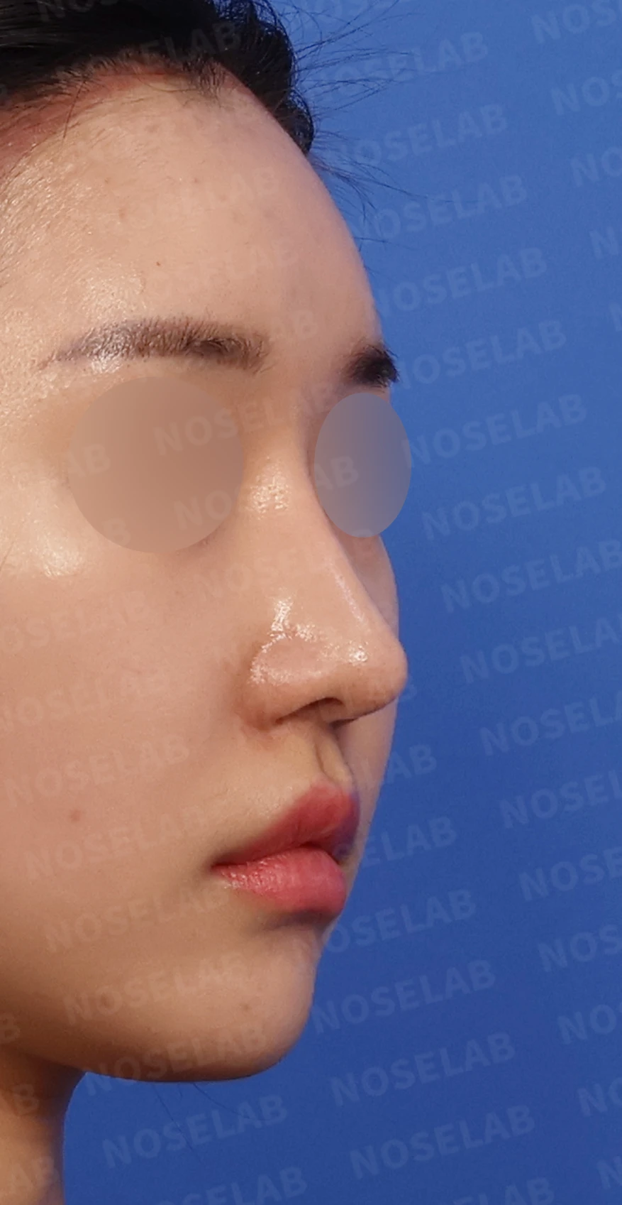 화살코와 복코가 함께 있는 코, 비중격 재건부터 시작하는 이유 — 디자인 상담 우측 측면, 비스듬한 측면, 비공 사진입니다.