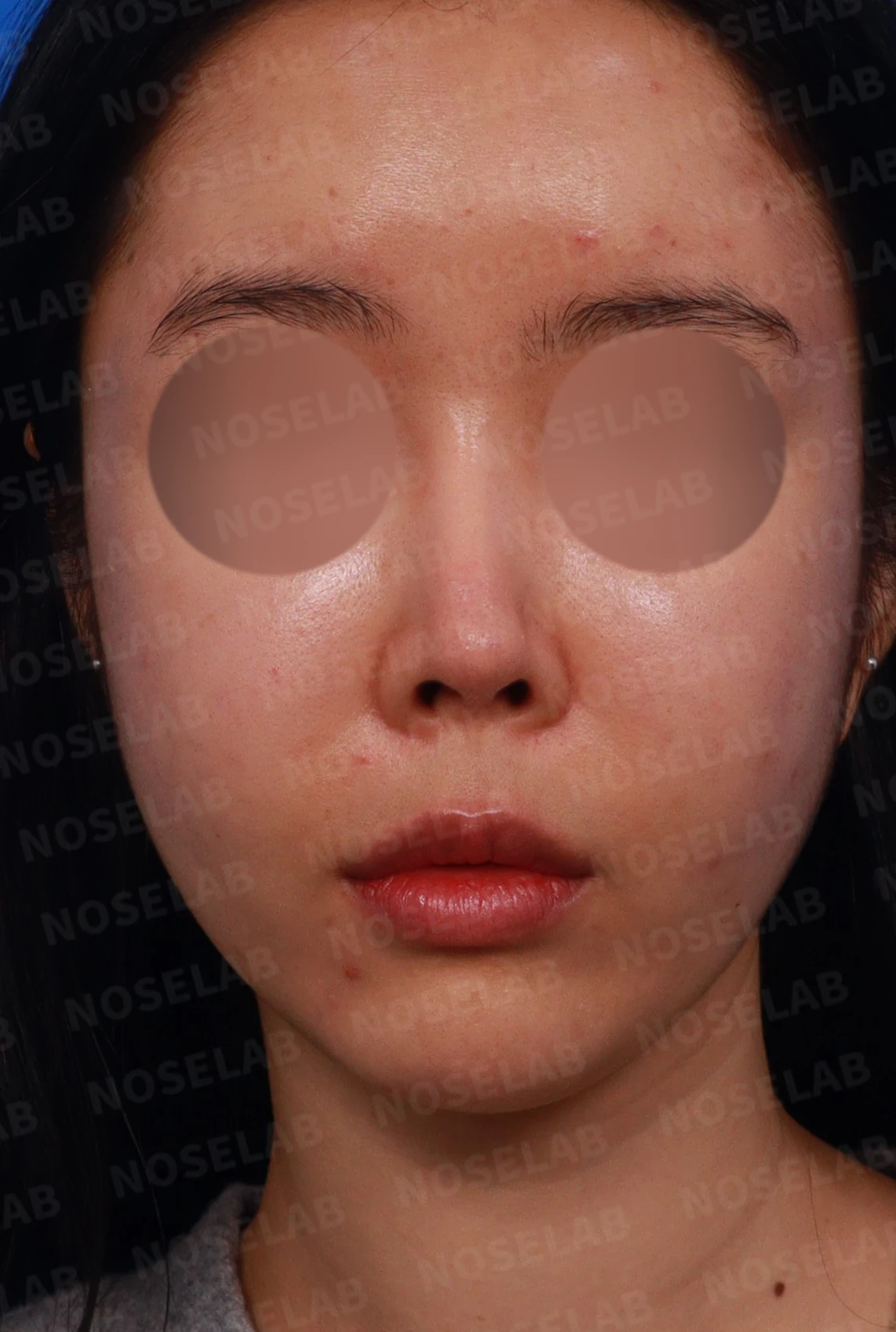 코가 들리고 콧기둥이 꺼지며 코끝이 찝혀 보이는 이유, 복합 교정은 어떻게 하나 — 디자인 상담 정면, 좌측 측면, 비스듬한 측면 사진