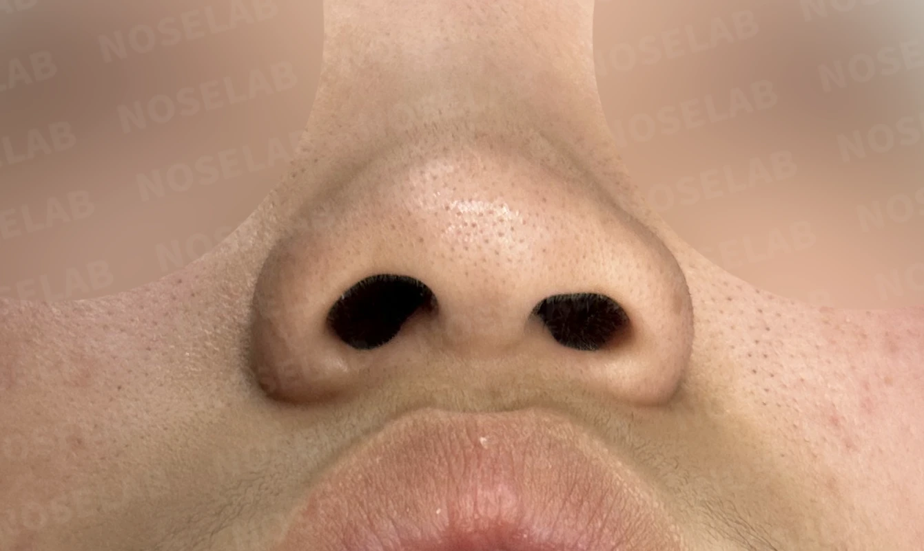 뭉툭한 코끝과 퍼진 코, 자가늑연골 비중격 연장술로 자연스럽게 교정 — 전(좌) 직후(후)