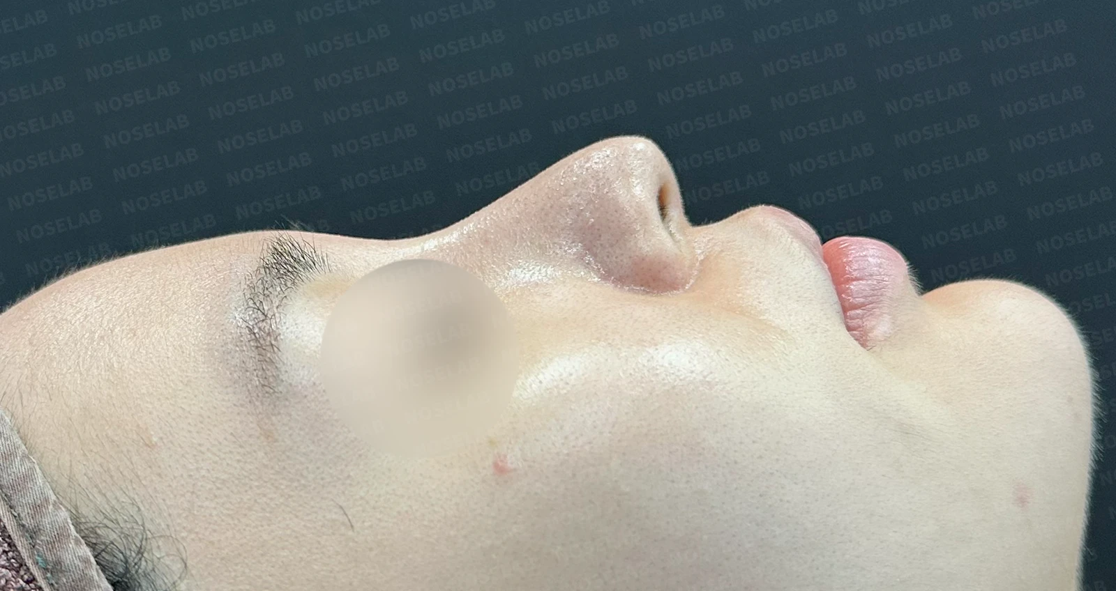여러 코 모양 고민을 함께 살펴보는 코성형 계획 — 수술 전 / 수술 직후 0일 직후 사진은 부기가 있는 상태로 최종 결과와 다를 수 있습니다.