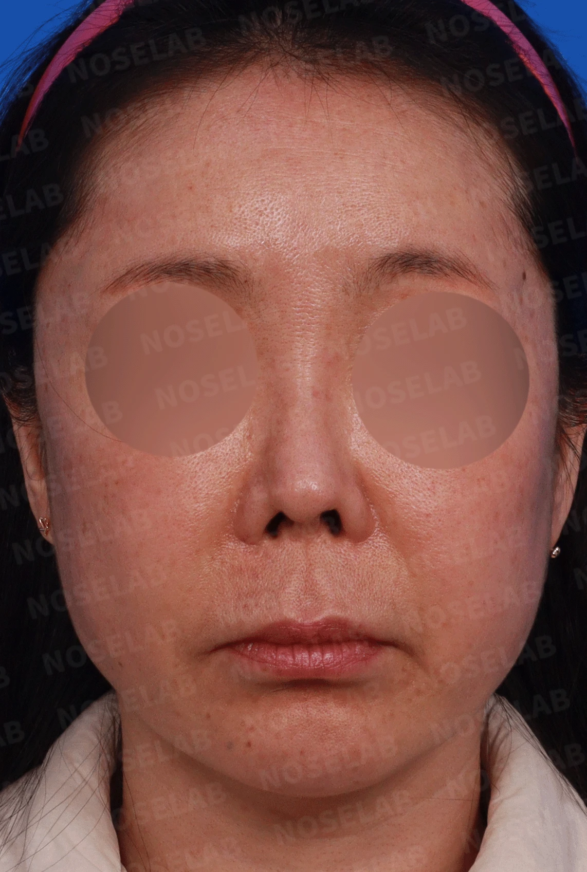 코가 짧고 들리며 비주가 함몰되는 이유, 자가 늑연골 재건은 어떻게 하나 — 디자인 상담 정면, 좌측 측면, 비스듬한 측면 사진