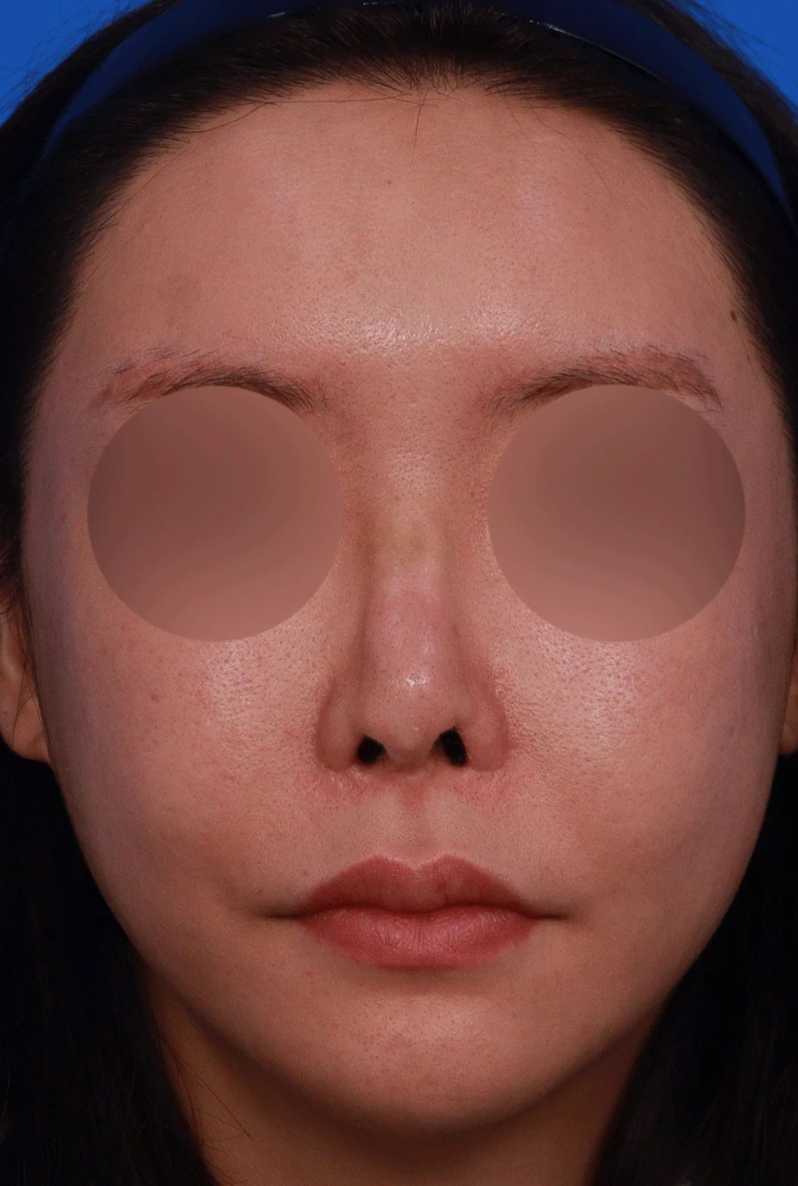 인공진피 이식 후 코끝이 비쳐 보이는 이유와 자가 늑연골 재건 방법 — 디자인 상담 정면 , 좌측 비스듬한 측면 , 측면 사진입니다.