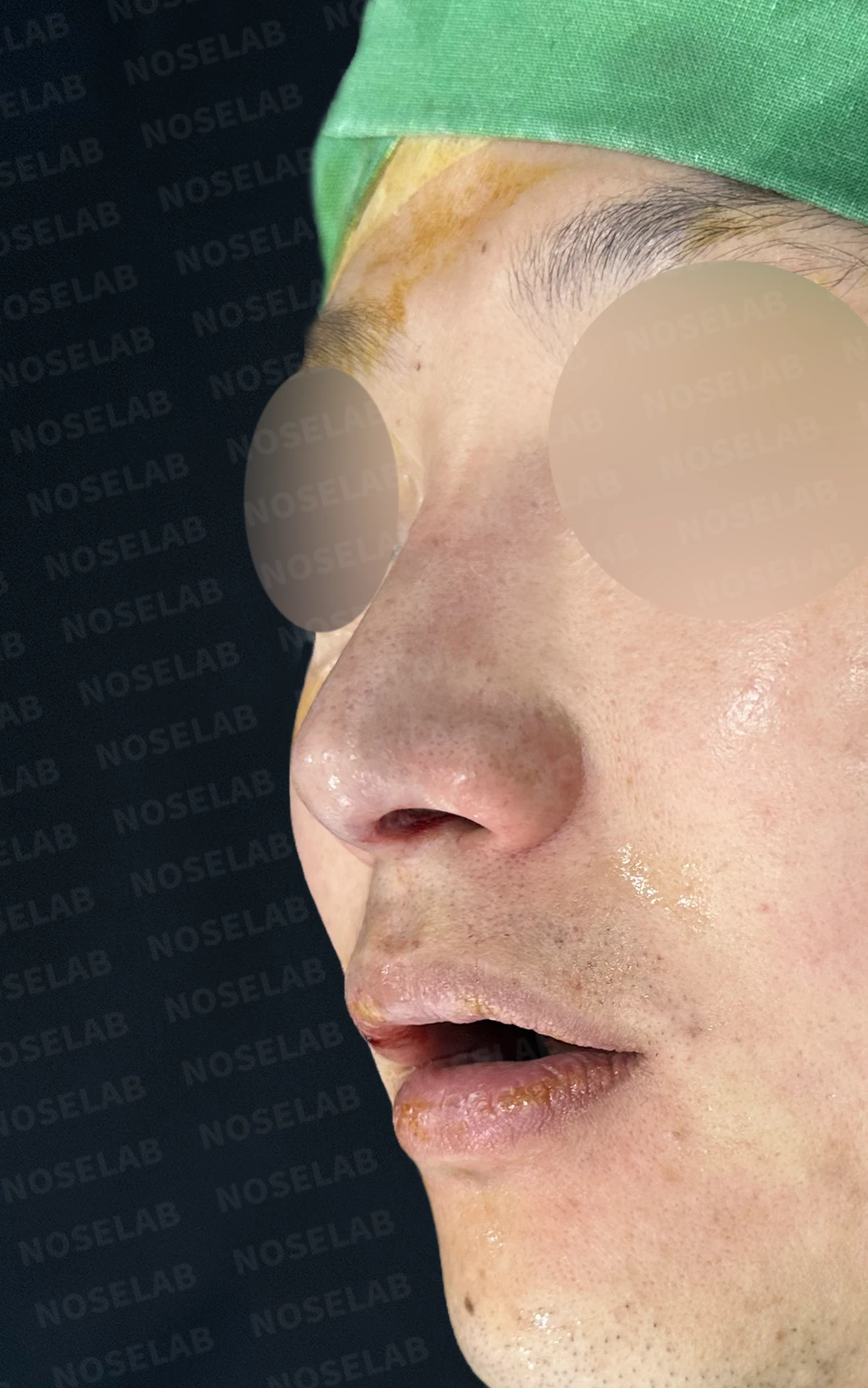 코막힘과 휘어진 비중격, 자가늑연골로 기능과 모양을 동시에 개선 — 전(좌) 직후(후)
