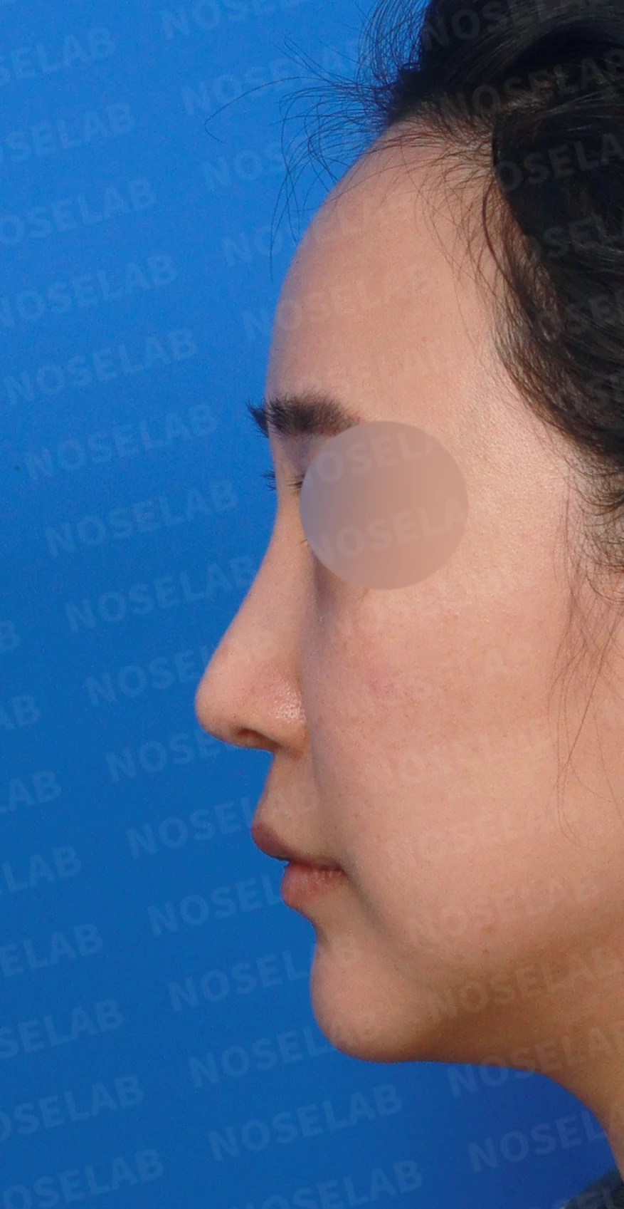 여러 번 수술한 코의 L-strut이 얇아지는 이유와 구조적 재건 방법 — 디자인 상담 정면, 좌측 측면, 비스듬한 측면 사진