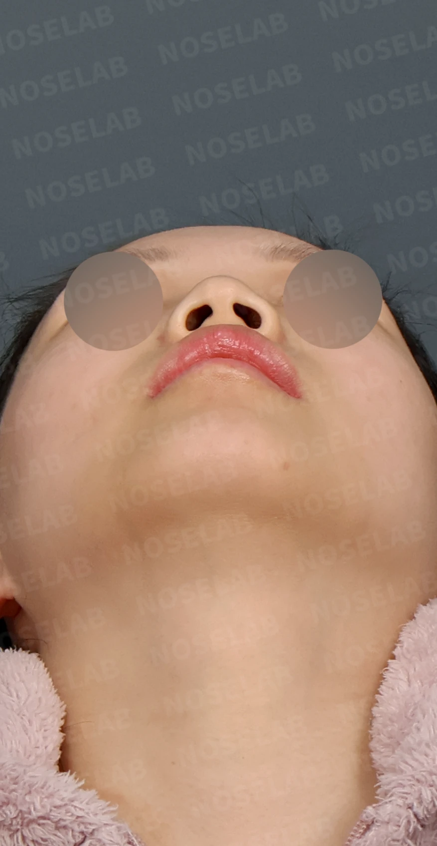 무보형물 코성형, 휘어진 콧대와 처진 코끝을 자연스럽게 교정 — 디자인 상담 우측 측면, 비스듬한 측면, 비공 사진입니다.