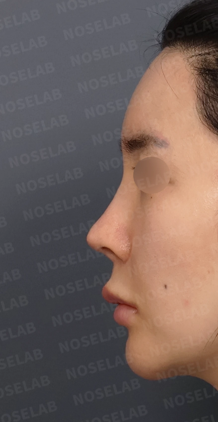 여러 차례 수술 뒤 코막힘이 남는 이유, 비중격과 비밸브 재건은 어떻게 하나 — 디자인 상담 정면, 좌측 측면, 비스듬한 측면 사진입니다.