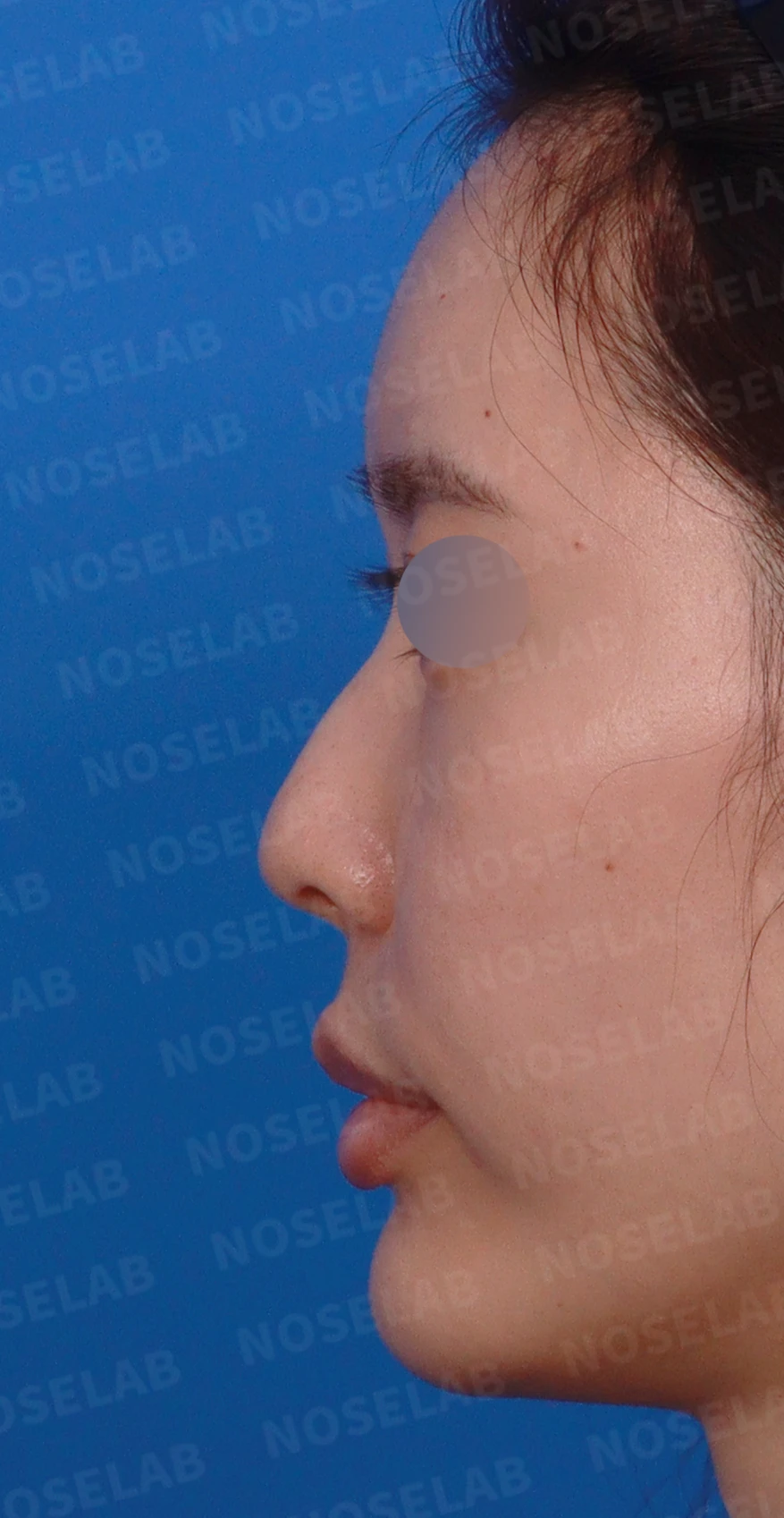 작고 처진 코와 코막힘이 함께 있을 때의 교정 방법 — 디자인 상담 정면, 좌측 측면, 비스듬한 측면 사진입니다