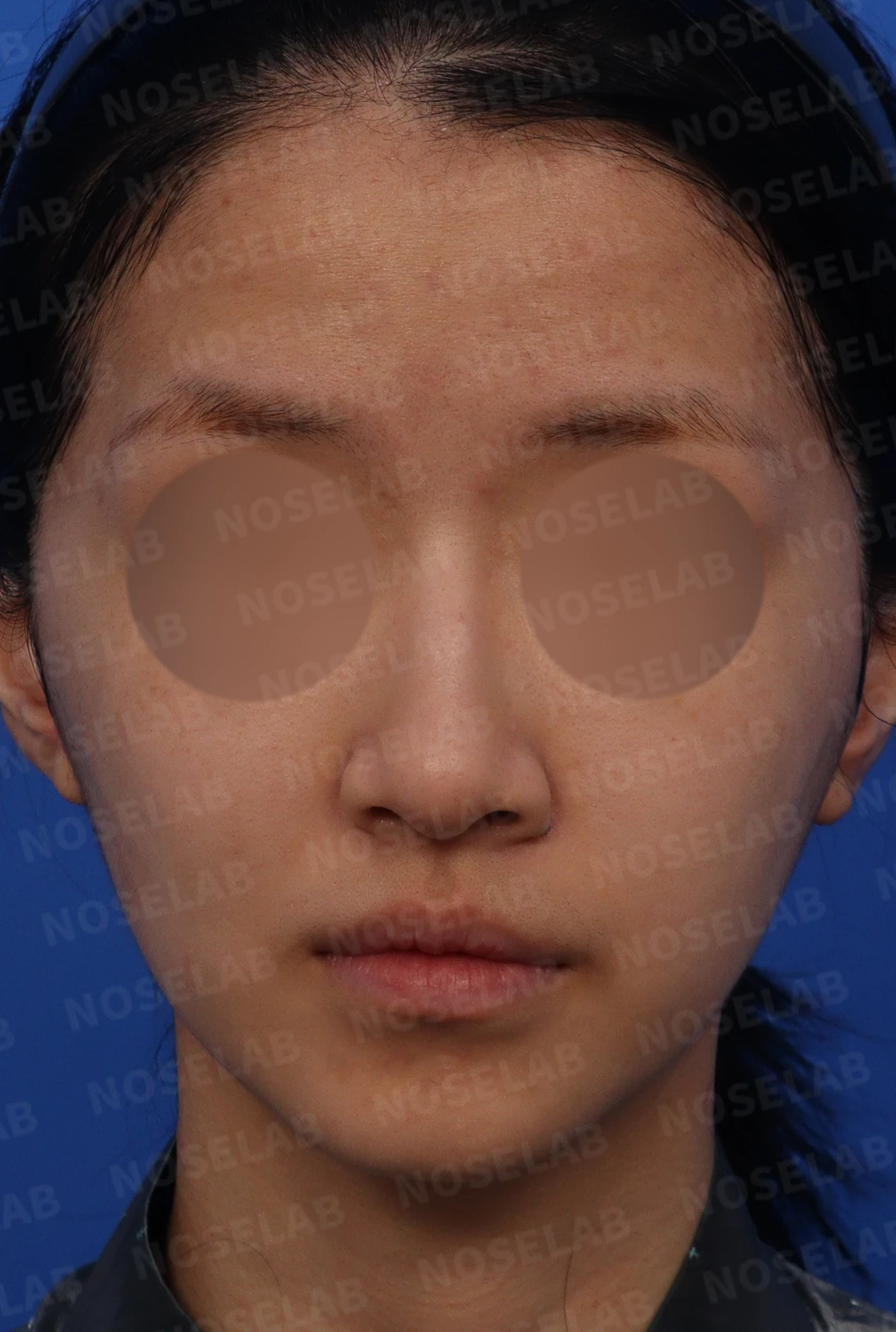 긴 코와 매부리코, 얼굴 비율을 고려한 교정 방법 — 디자인 상담 정면, 우측 비스듬한 측면, 측면 사진입니다.