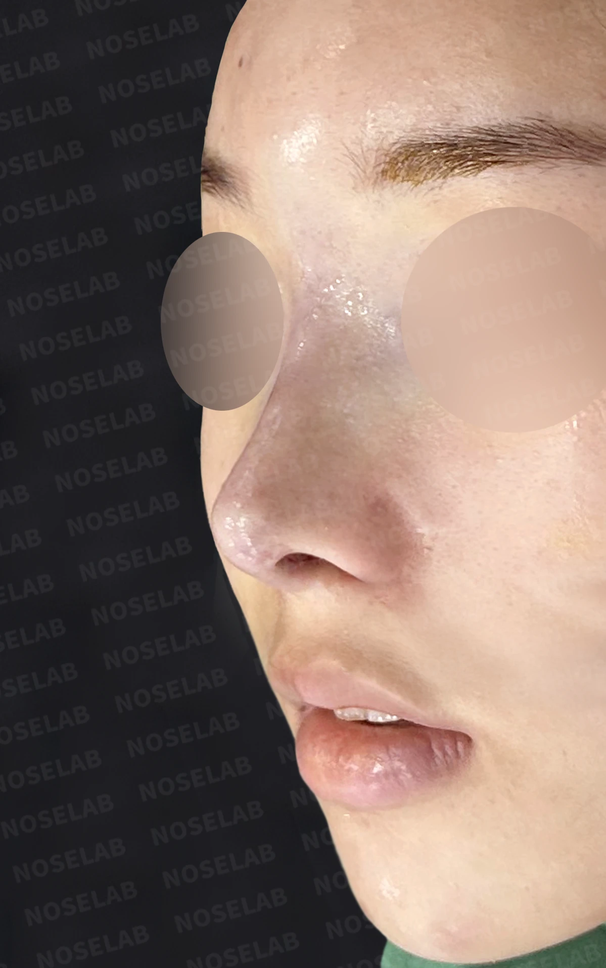 콧대가 넓고 단차져 보이는 이유, 절골술과 늑연골 코끝 성형은 어떻게 하나 — 수술 전 / 수술 직후 0일 직후 사진은 부기가 있는 상태로 최종 결과와 다를 수 있습니다.
