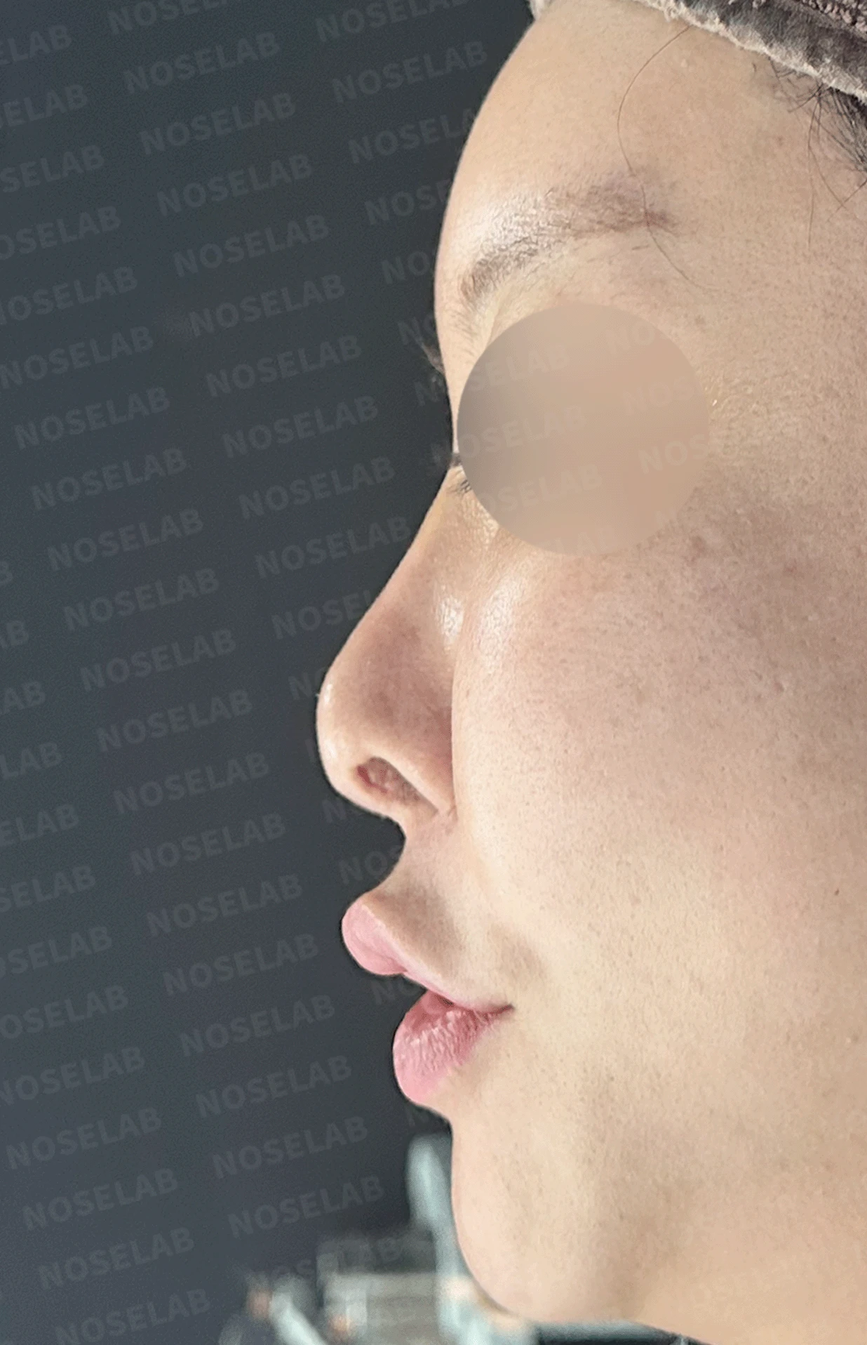 인공진피 이식 후 코끝이 비쳐 보이는 이유와 자가 늑연골 재건 방법 — 본문 사진 10