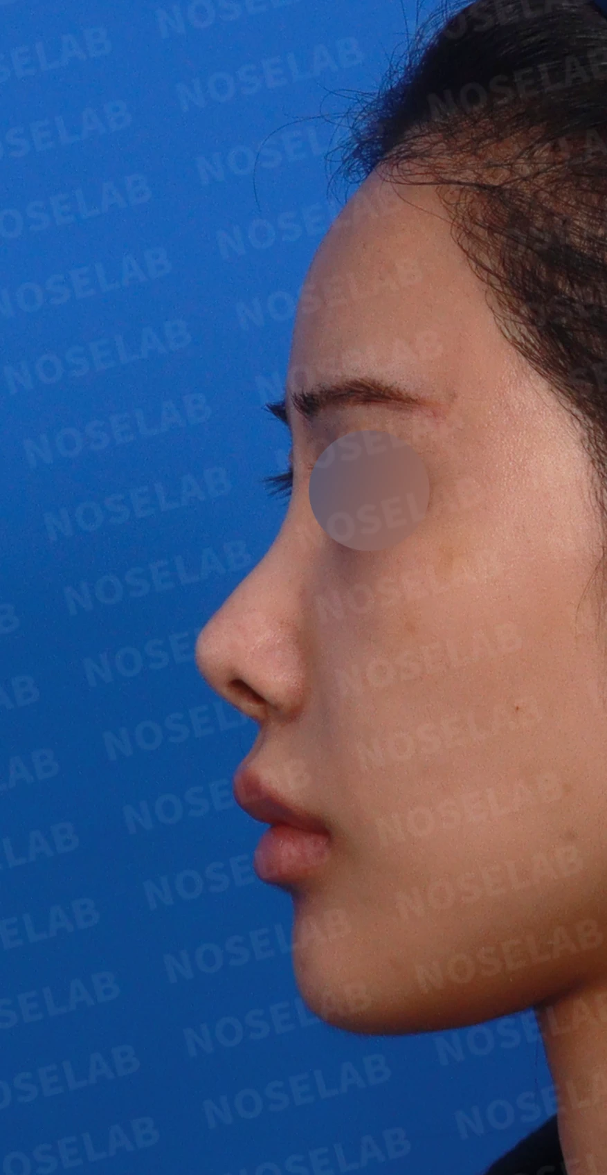콧대 반영구 필러가 남기는 변화와 제거 후 비중격 재건 — 디자인 상담 정면, 좌측 측면, 비스듬한 측면 사진입니다.