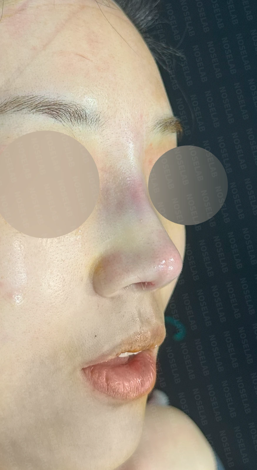실리콘 부작용 후 자가늑연골로 재건하는 방법 — 수술 직후 0일 정면, 측면, 비스듬한 측면 직후 사진은 부기가 있는 상태로 최종 결과와 다를 수 있습니다.