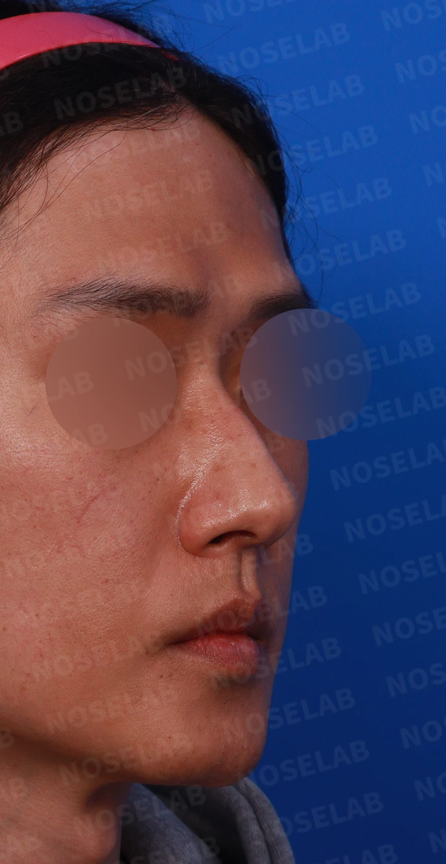 안면 비대칭이 있는 코에 맞춤형 보형물을 쓰는 이유와 매부리 교정 방법 — 디자인 상담 우측 측면,비스듬한 측면, 비공 사진입니다.