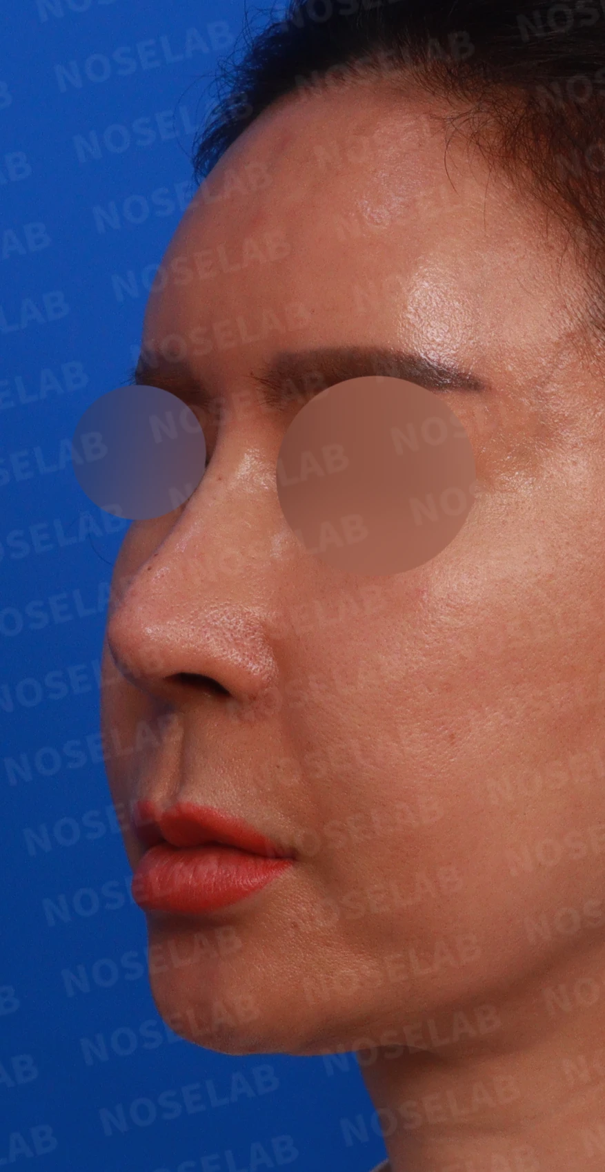 휜코와 뭉툭한 코끝, 콧구멍 비대칭의 비개방 교정 방법 — 수술전 디자인 상담 정면, 좌측 비스듬한 측면, 좌측 측면