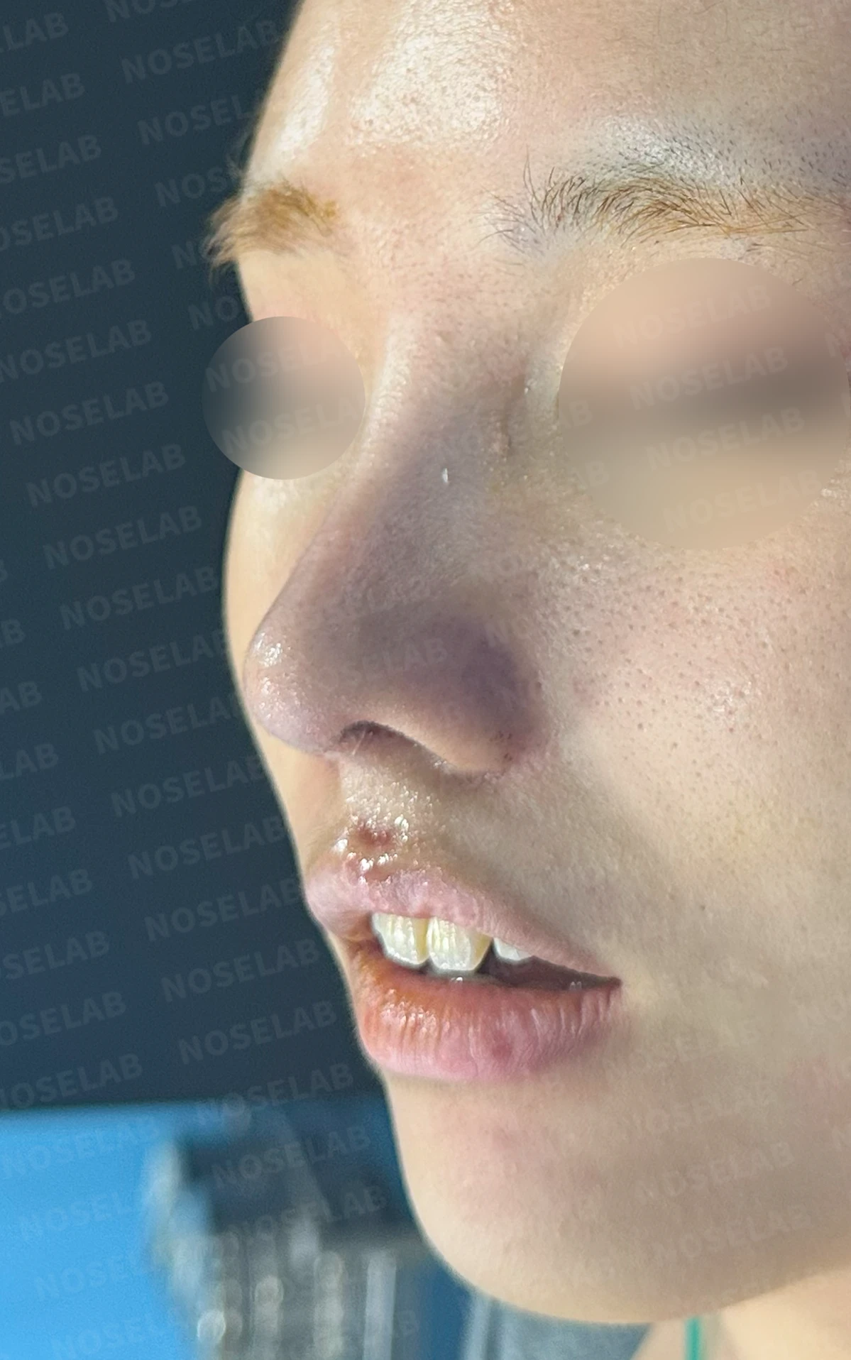 작고 뭉툭한 코는 어디까지 높일 수 있나 — 피부의 한계와 재건 방법 — 수술 직후 0일 정면 , 비스듬한 측면 , 측면 사진입니다. 직후 사진은 부기가 있는 상태로 최종 결과와 다를 수 있습니다.