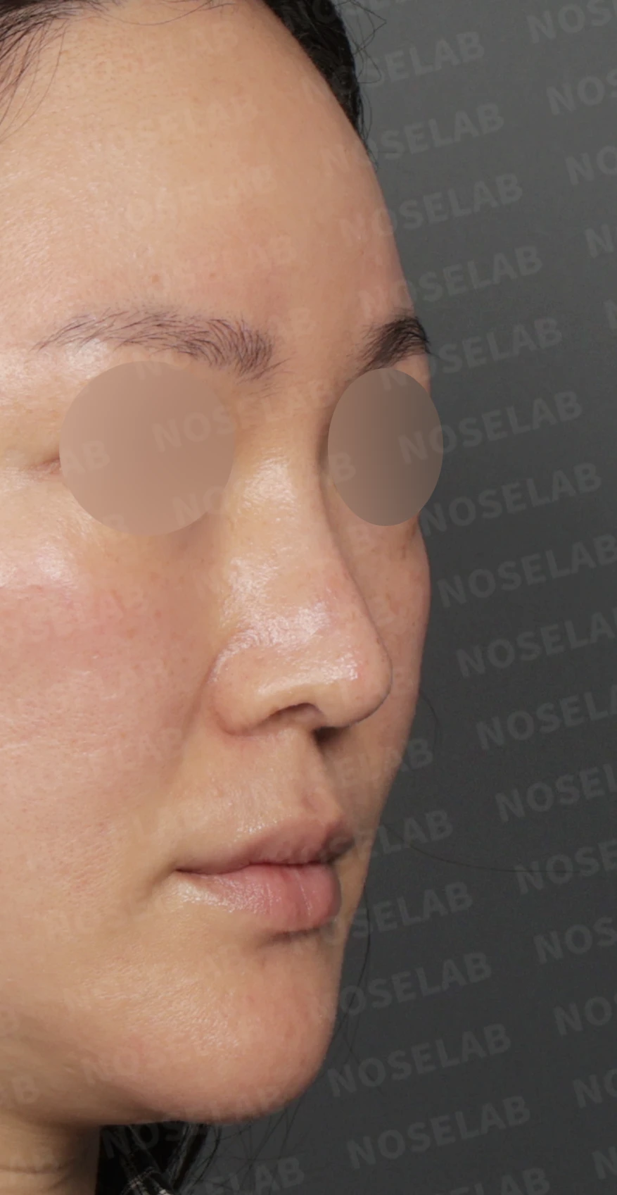 길고 처진 코 교정, 자가늑연골 비중격 재건과 콧대 보형물 교체로 완성한 코재수술 — 디자인 상담 우측 측면 , 비스듬한 측면 , 비공 사진 입니다.