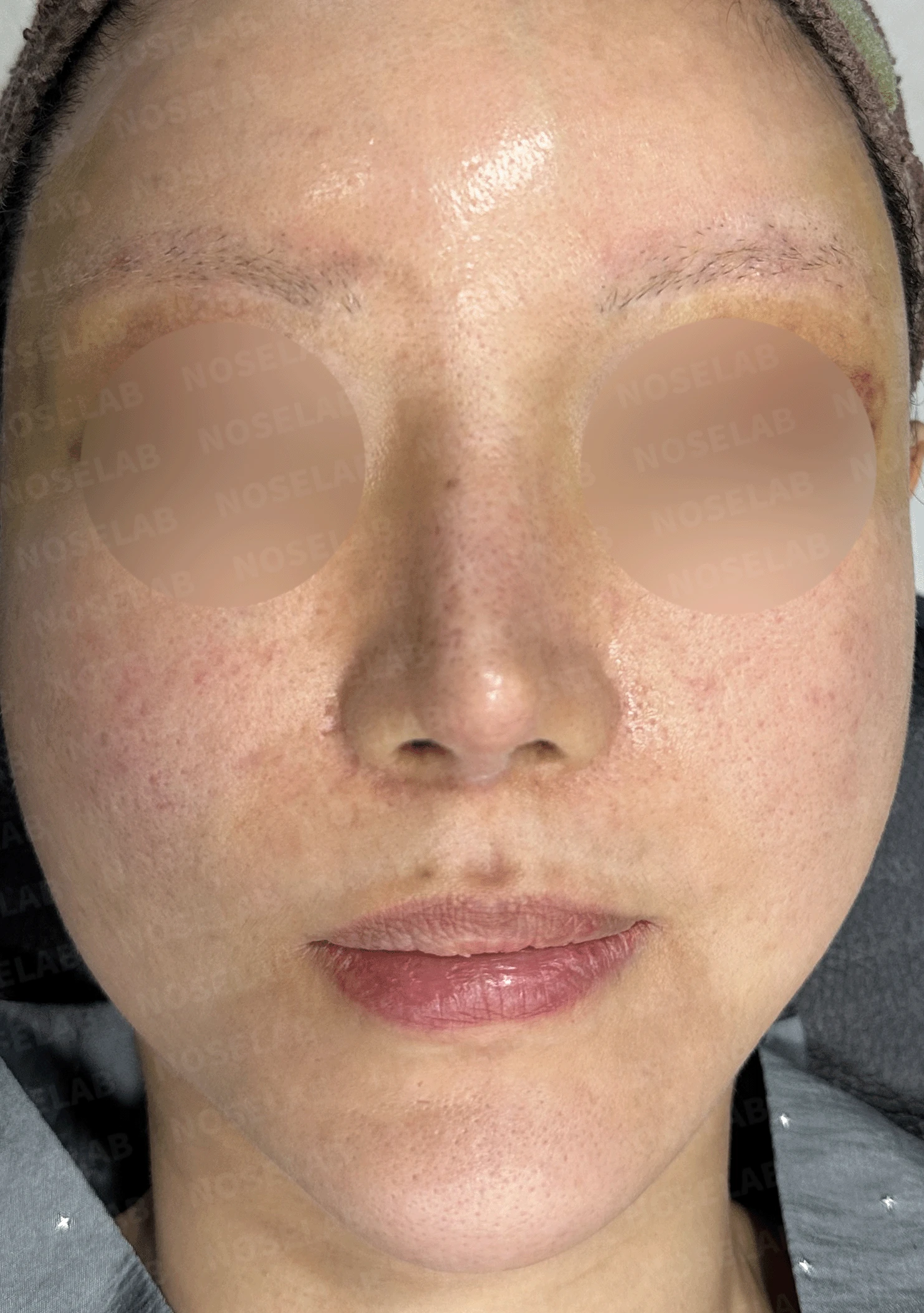 여러 차례 재수술로 코에 쓸 연골이 남지 않았을 때, 재건은 어떻게 하나 — 본문 사진 7