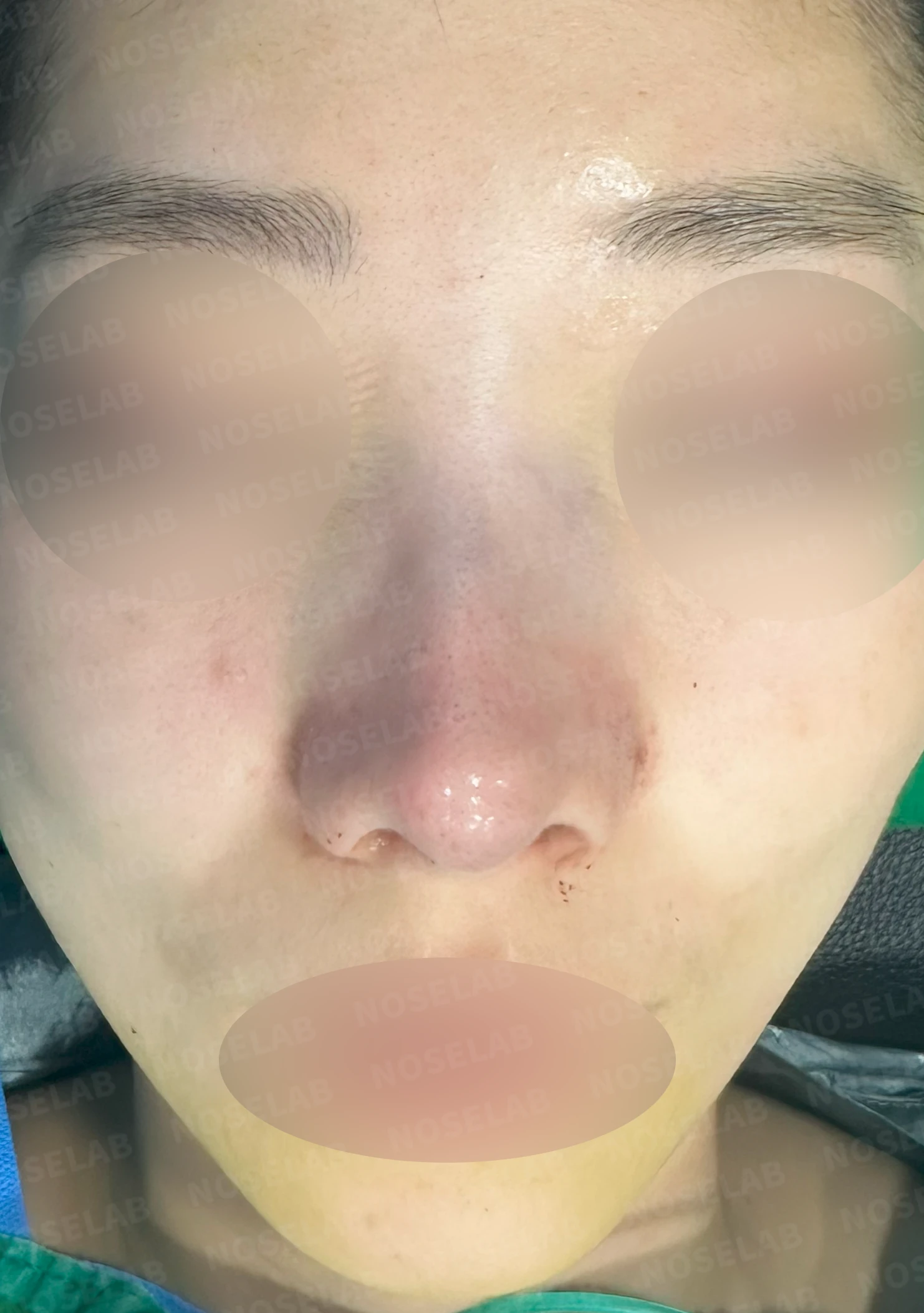 매부리를 정리한 뒤 콧등이 눌려 보이고 코끝이 뭉툭해지는 이유, 보형물 없이 교정하는 방법 — 수술 직후 0일 정면, 측면, 비스듬한 측면 사진 직후 사진은 부기가 있는 상태로 최종 결과와 다를 수 있습니다.
