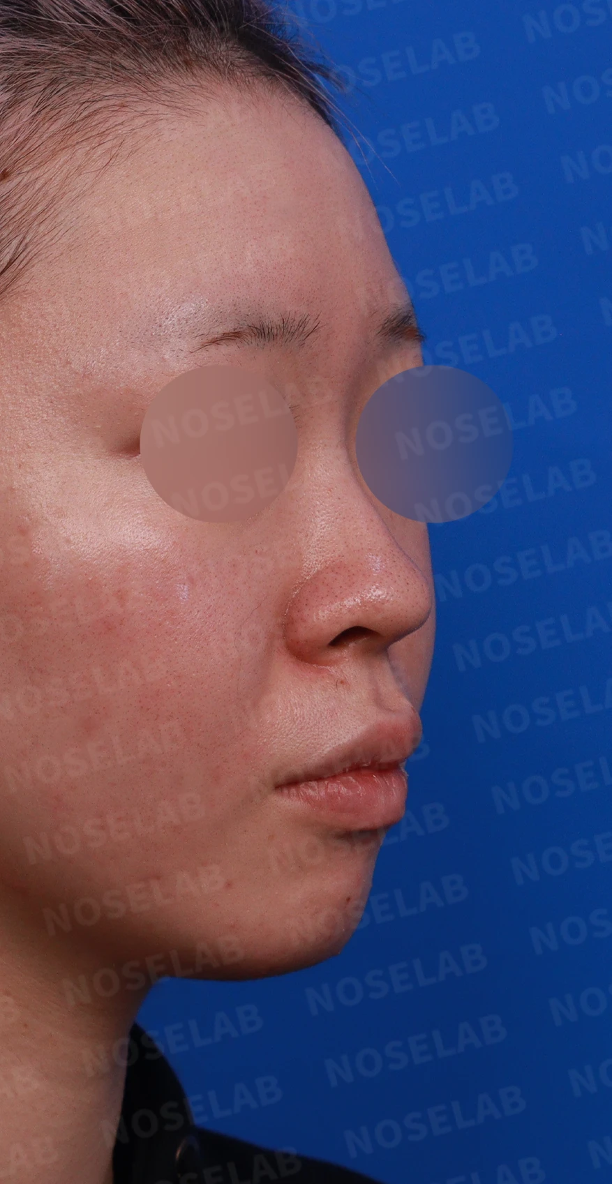 퍼진코, 복코 교정으로 균형 잡힌 이미지 완성 — 디자인 상담 정면, 우측 비스듬한 측면, 측면 사진입니다.