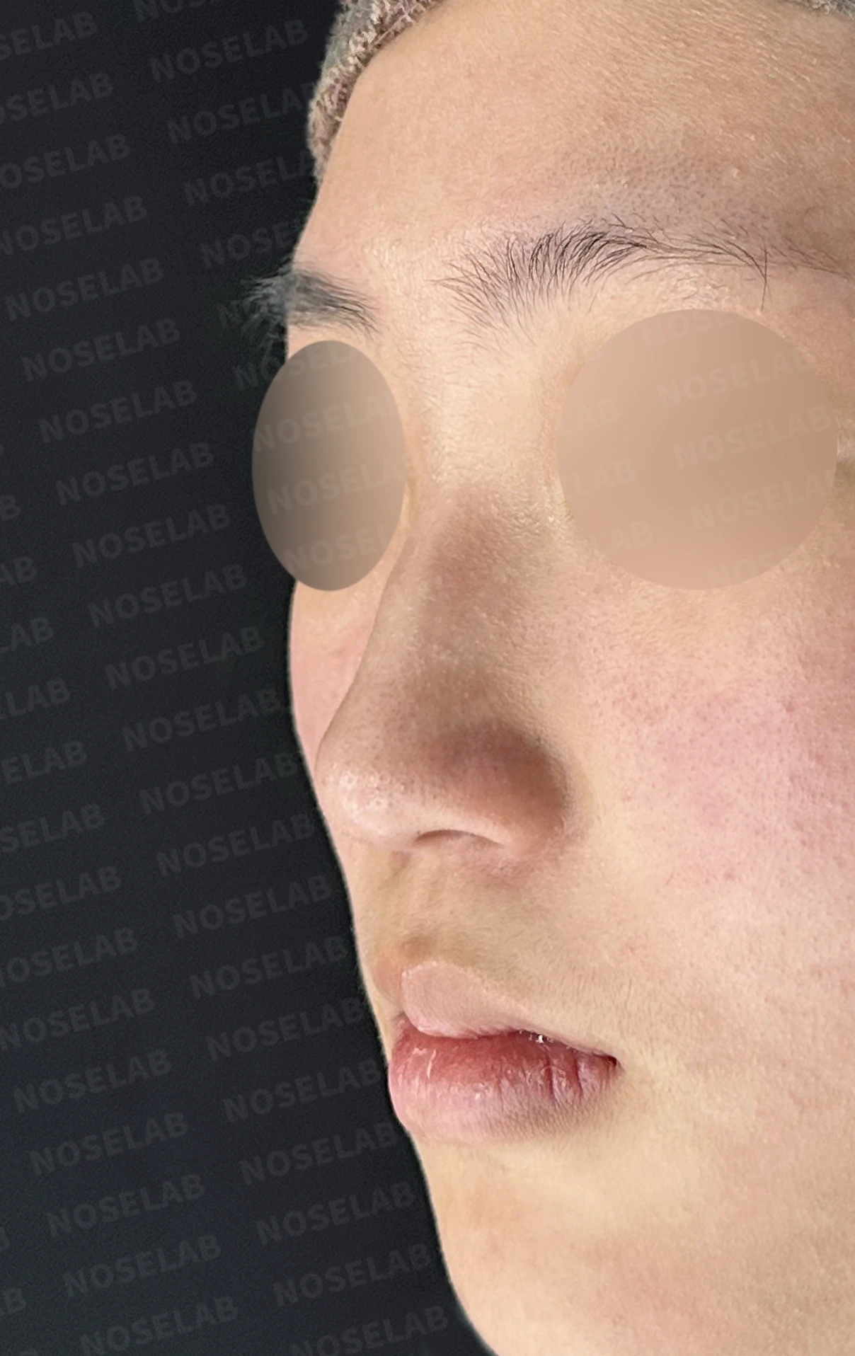 작은 콧날개 연골과 처진 코끝, 자가늑연골과 외측절골술로 자연스럽게 교정 — 전(좌) 직후(후)