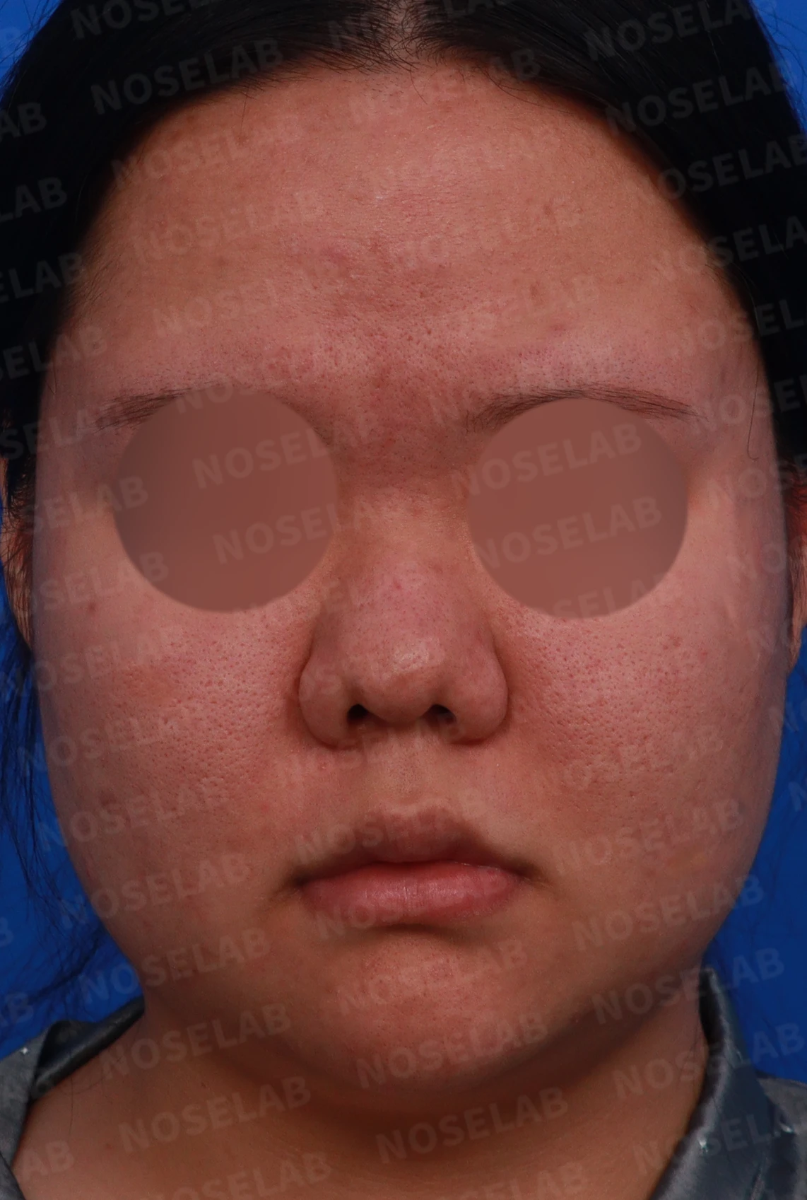 복코와 짧은 코, 비주 함몰이 함께 나타나는 이유와 코끝 입체감을 만드는 방법 — 디자인 상담 정면, 좌측 측면, 비스듬한 측면 사진