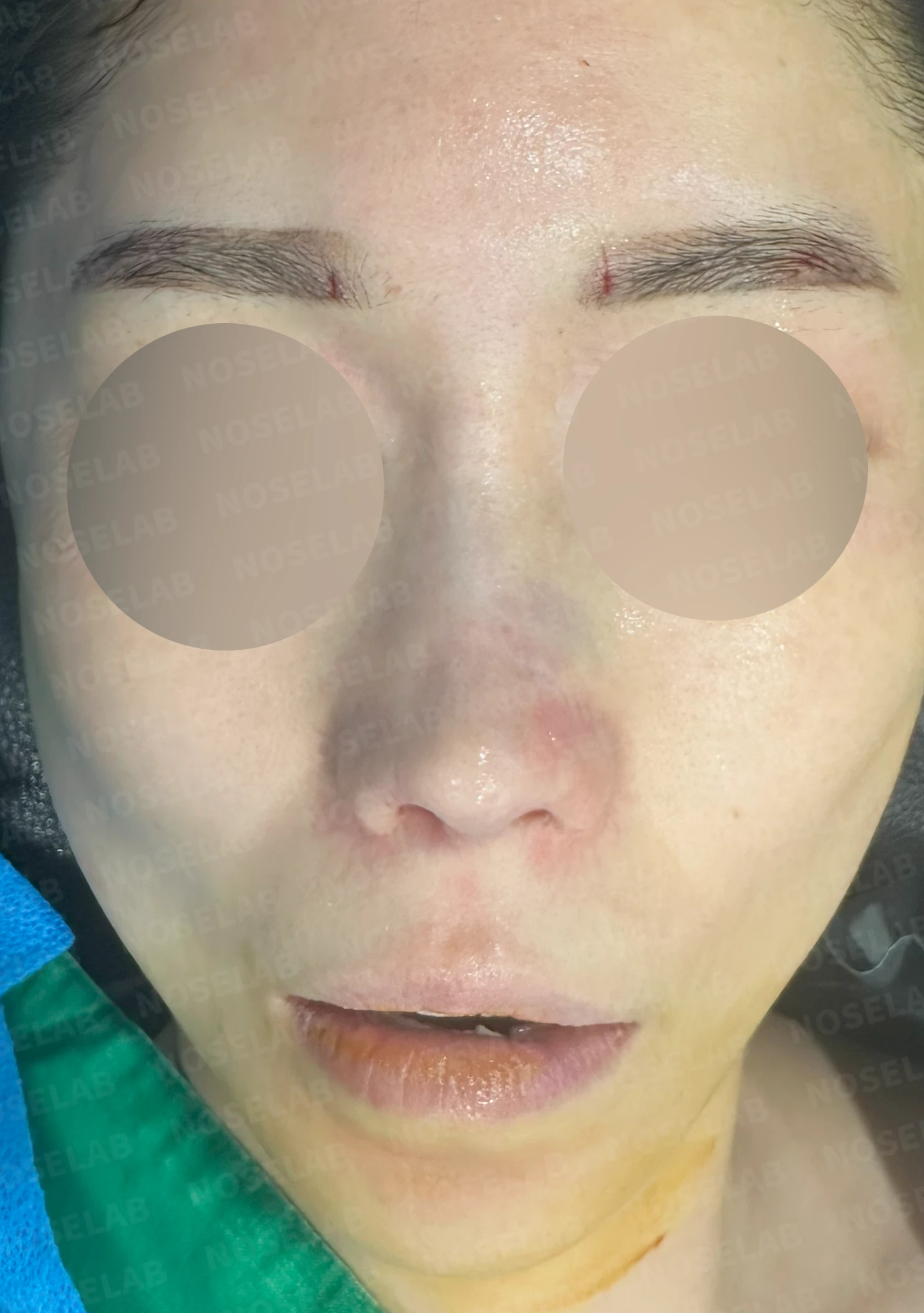 비공 비대칭과 들린코 교정 - 자가늑연골 재건 실제 후기 — 전(좌) 직후(우)