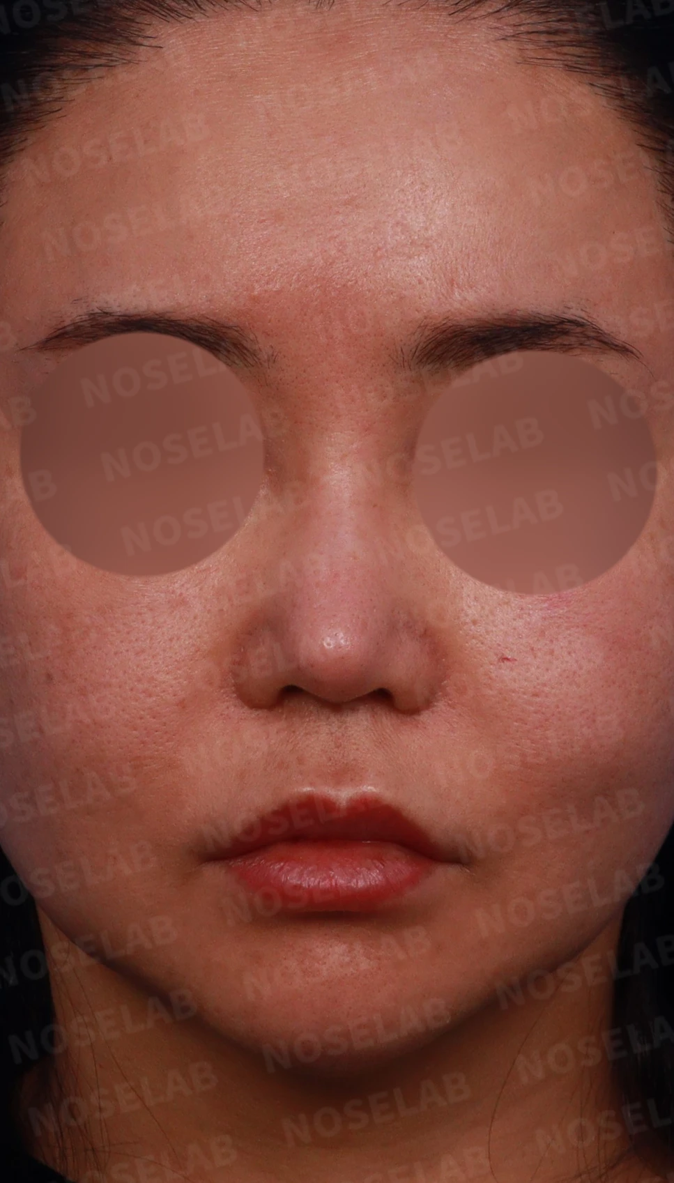 코재수술에서 비중격을 재건하는 방법 — 디자인 상담 정면, 좌측 비스듬한 측면, 측면 사진