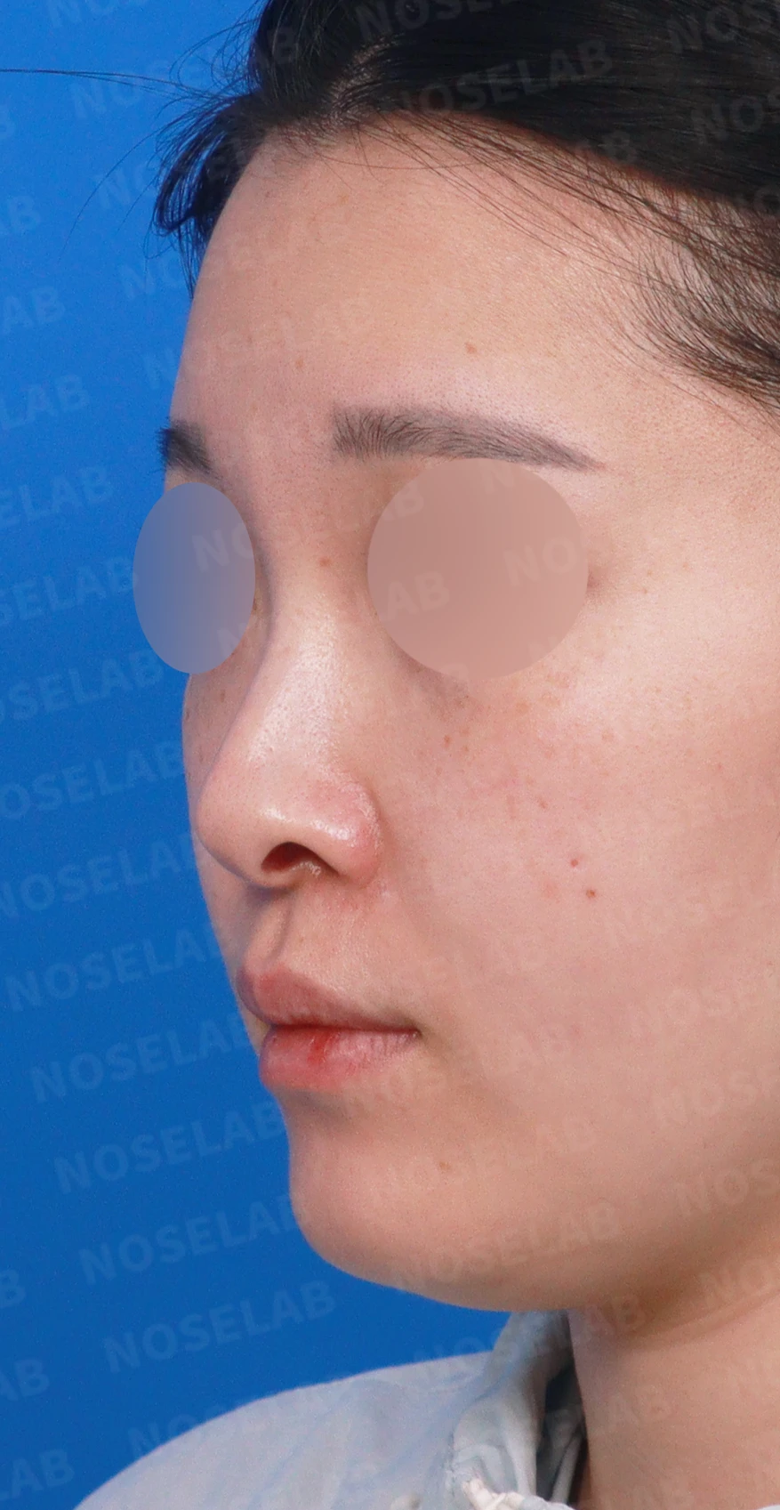처진 비주 교정, 휜 코와 비공 비대칭까지 완벽하게 — 디자인 상담 정면, 좌측 측면, 비스듬한 측면 사진입니다.