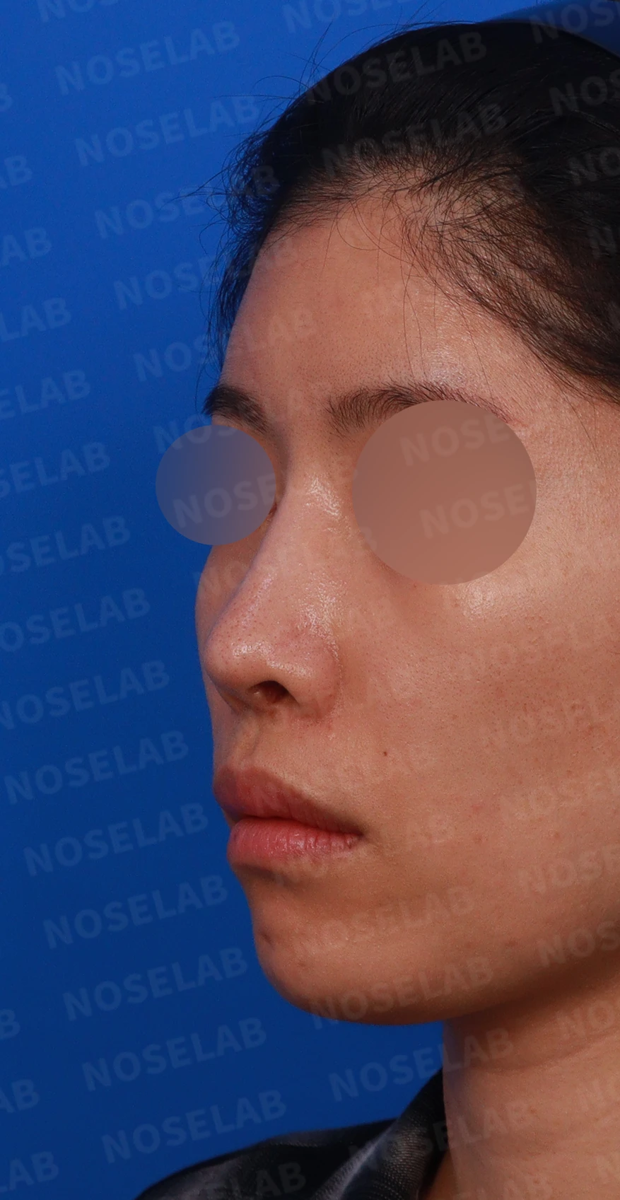 코 수술 뒤 염증이 오래 지속되면 생기는 변화와 재건 방법 — 디자인 상담 정면, 비스듬한 측면, 좌측 측면 사진입니다.
