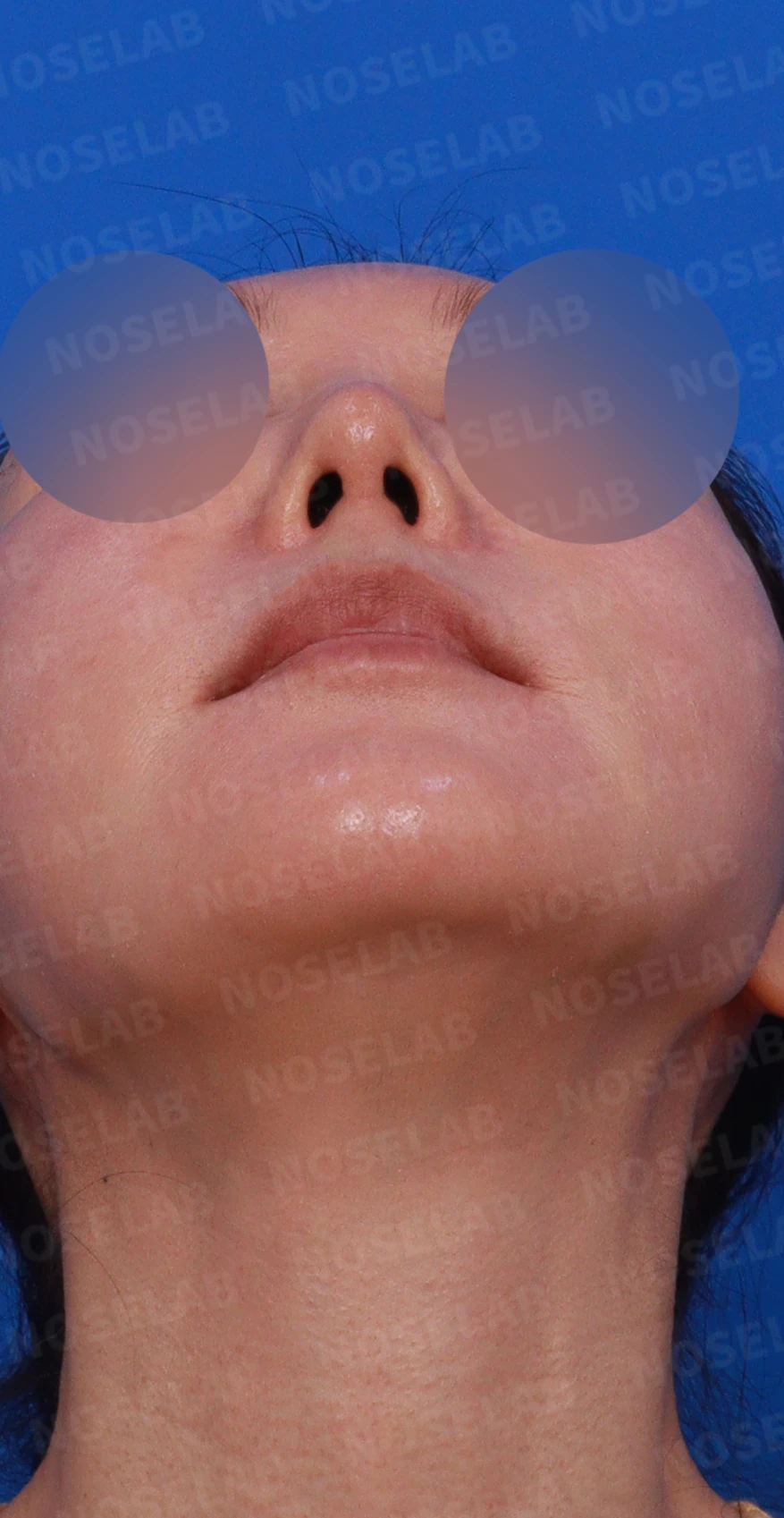 매부리를 깎은 뒤 다시 매부리가 보이고 콧구멍이 드러나는 이유 — 디자인 상담 우측 비스듬한 측면, 측면, 비공 사진
