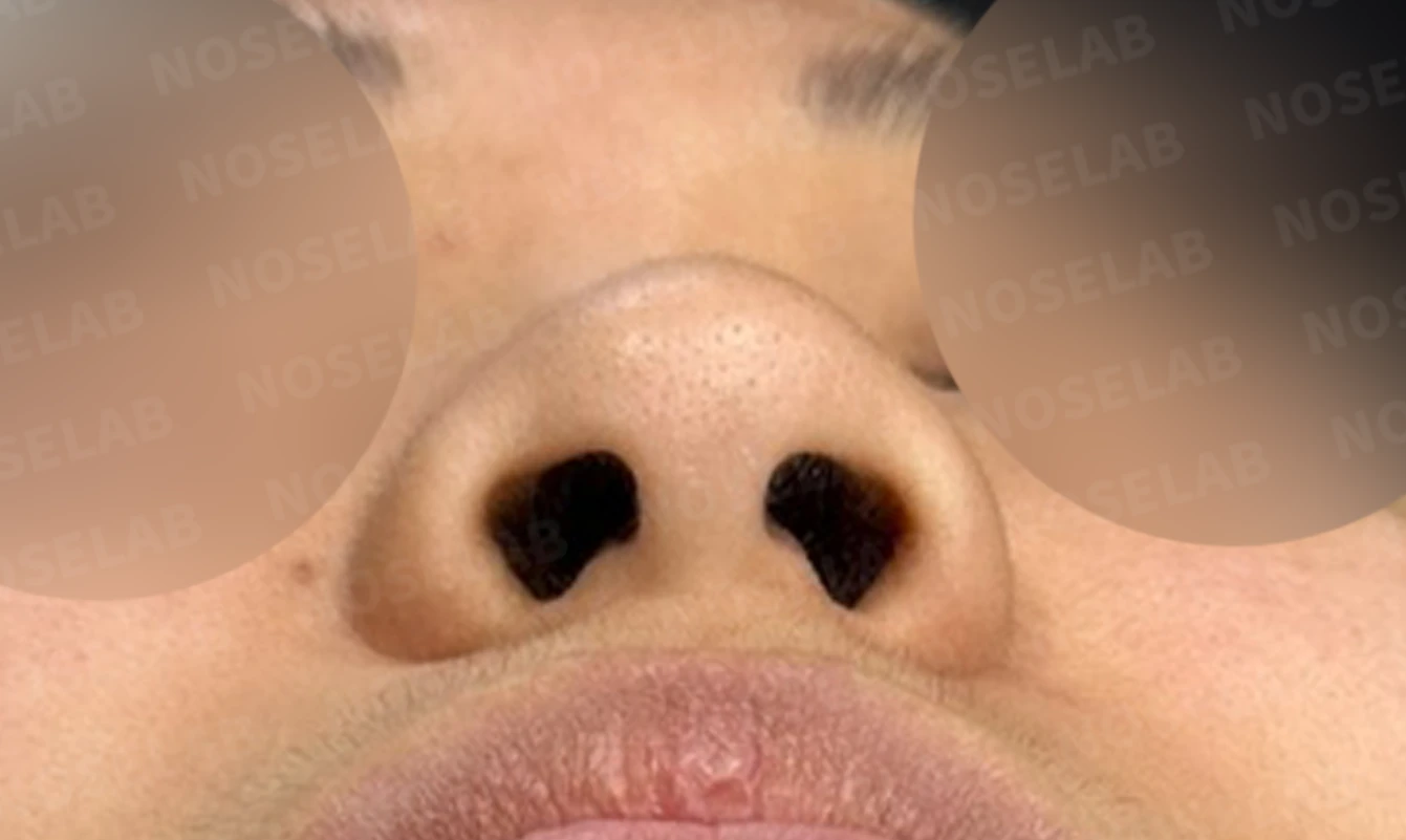뭉툭하게 퍼진 코끝이 생기는 이유, 자가 늑연골 비중격 연장으로 직반 라인을 만드는 방법 — 수술 전 / 수술 직후 0일 직후 사진은 부기가 있는 상태로 최종 결과와 다를 수 있습니다.