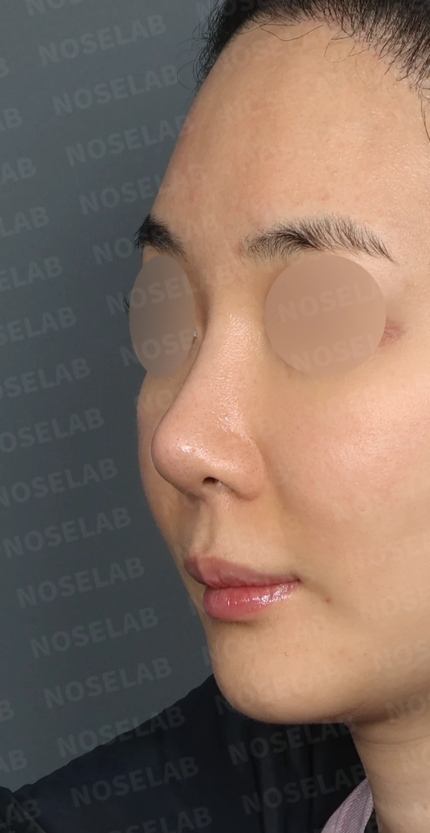 L자 보형물 제거 후 자가 늑연골로 코끝을 교정한 코재수술 — 디자인 상담 정면, 좌측 측면, 비스듬한 측면 사진