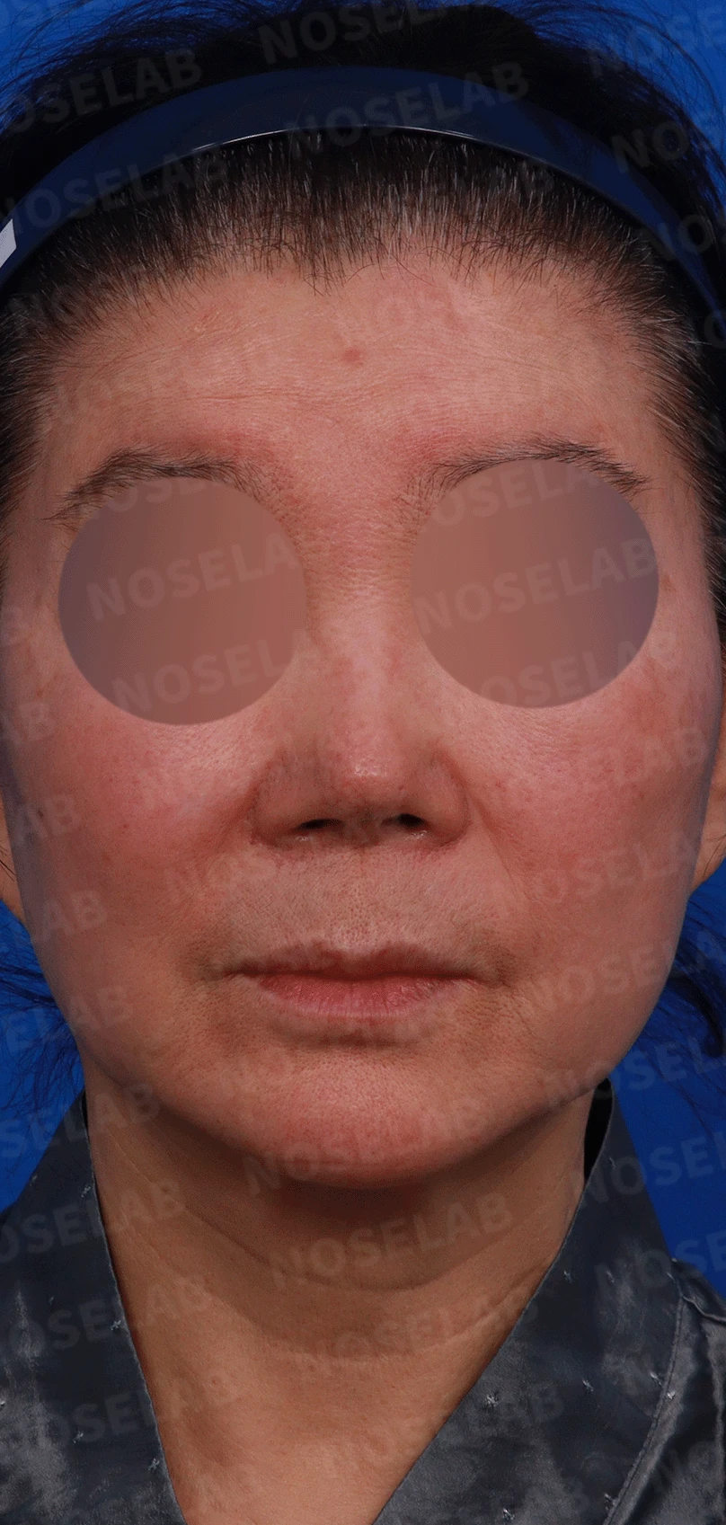 오래된 코 보형물과 코 통증, 재수술에서 확인할 점 — 디자인 상담 정면, 좌측 측면, 비스듬한 측면 사진입니다.