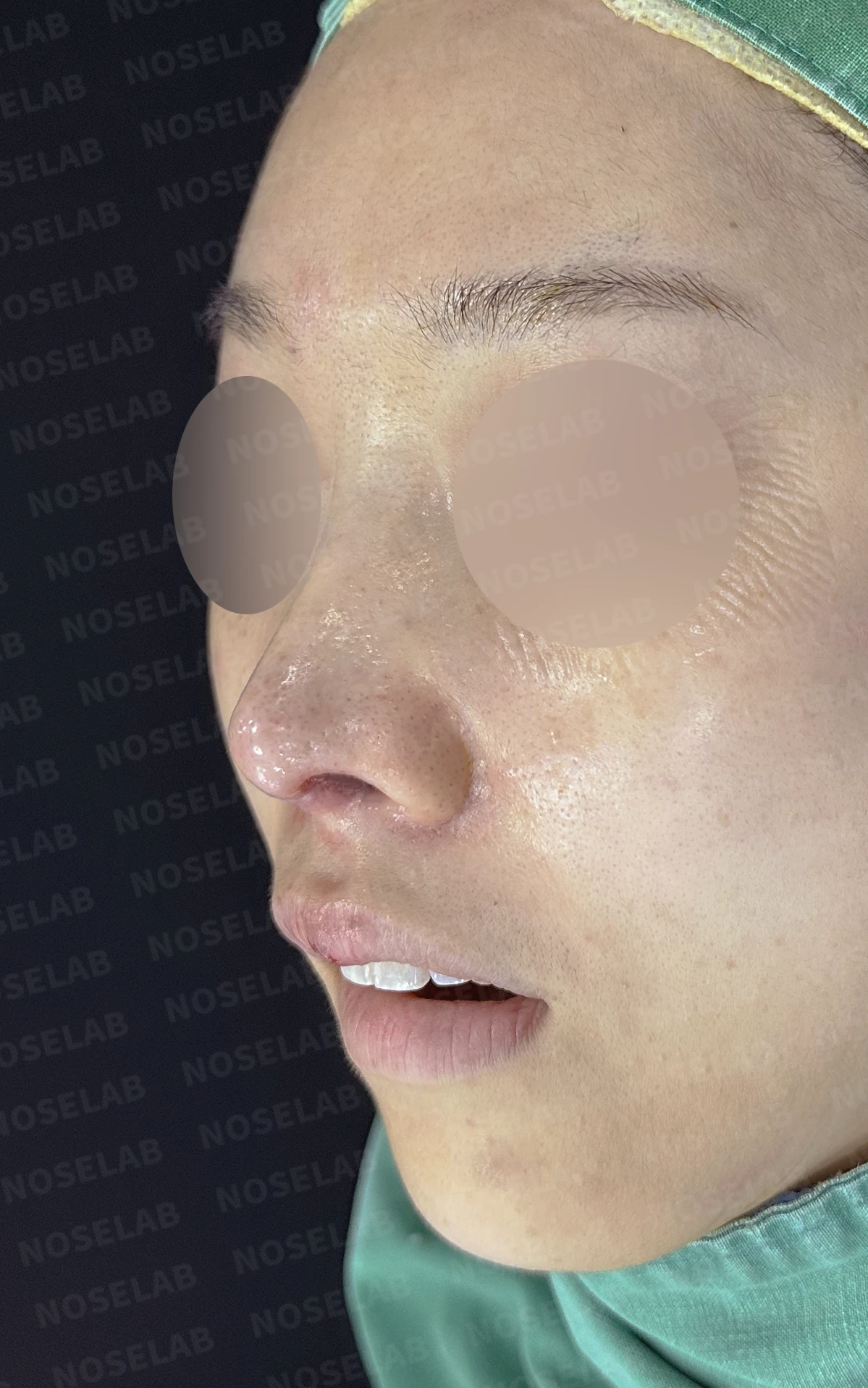 코끝 피부가 얇아져 연골이 비치는 이유, 피부 보강은 어떻게 하나 — 수술 전 / 수술 직후 0일 직후 사진은 부기가 있는 상태로 최종 결과와 다를 수 있습니다.