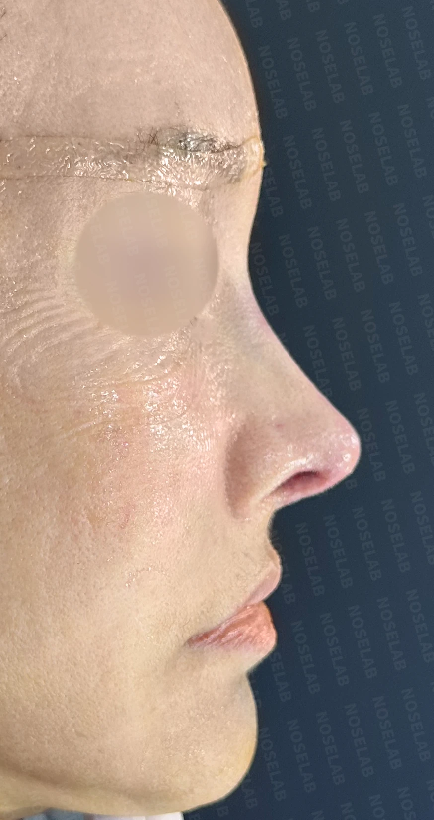 코의 높이와 입체감을 고려한 수술 계획 — 수술 직후 0일 90도, 45도, 정면 사진 직후 사진은 부기가 있는 상태로 최종 결과와 다를 수 있습니다.